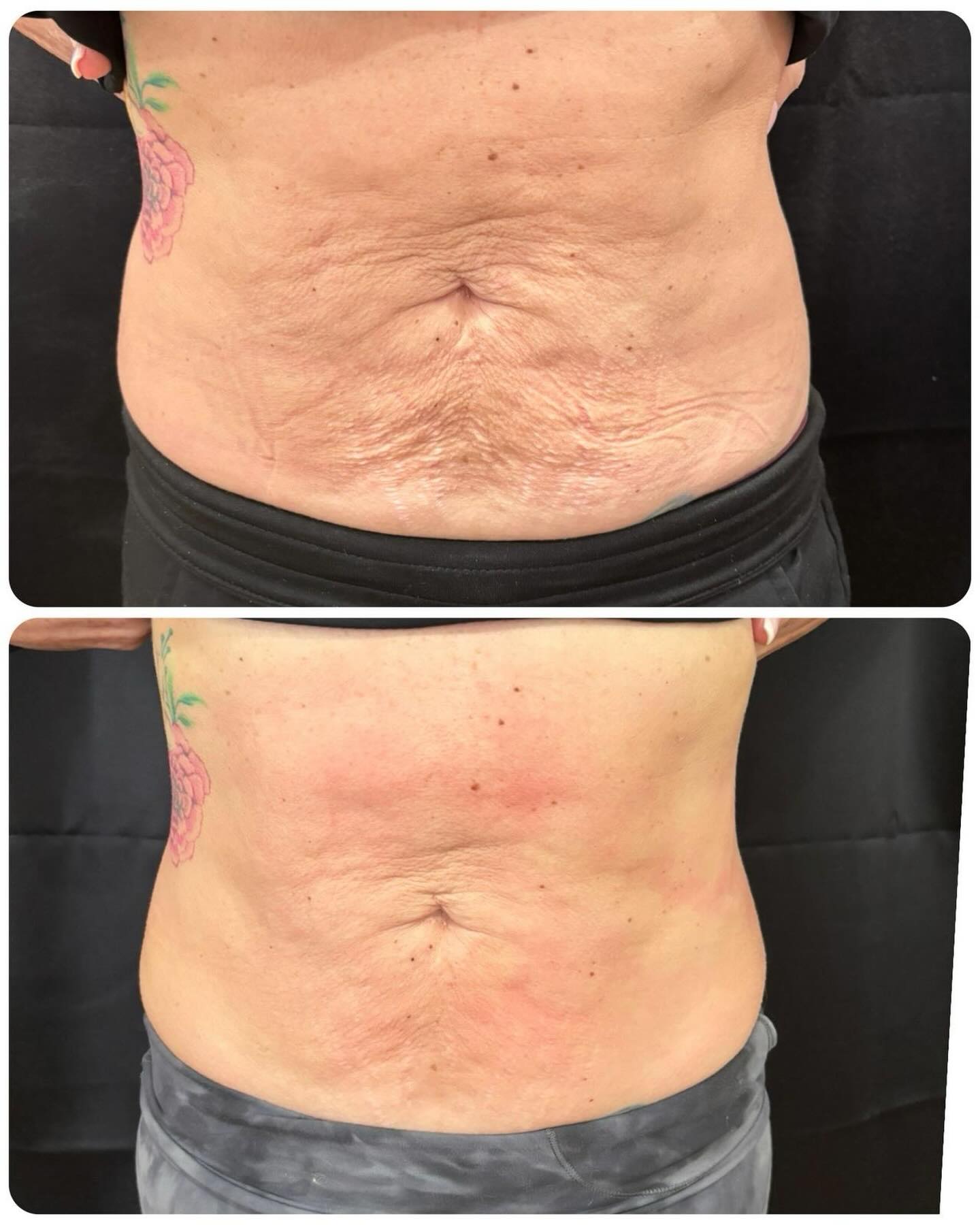 Happy T-Shape Tuesday! 🔥Check out this before and after abdomen transformation. Get your transformation
today!
REMINDER: Buy 12 or more sessions in March get 15% off!✨🩷