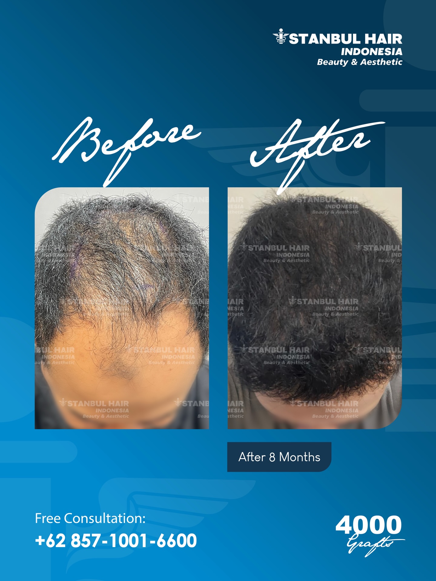 4.000 grafts — 8 bulan pasca tindakan
Proses yang dirancang dengan presisi kini mencapai fase kematangan. Kepadatan tampak lebih menyatu, garis depan terbentuk harmonis dengan proporsi yang natural dan elegan.
Hasil yang tidak hanya terlihat — tetapi terasa sebagai bagian dari identitas baru.
⸻
4,000 grafts — 8 months post procedure
A journey shaped by precision has reached its refined phase. Enhanced density blends seamlessly, while the frontal line emerges in balanced, natural elegance.
A result that is not only seen — but experienced as a renewed sense of self.
📍 Istanbul Hair Indonesia
📞 +62 857-1001-6600
#IstanbulHairIndonesia #4000Grafts #8MonthsResult #NaturalElegance #RefinedHairline