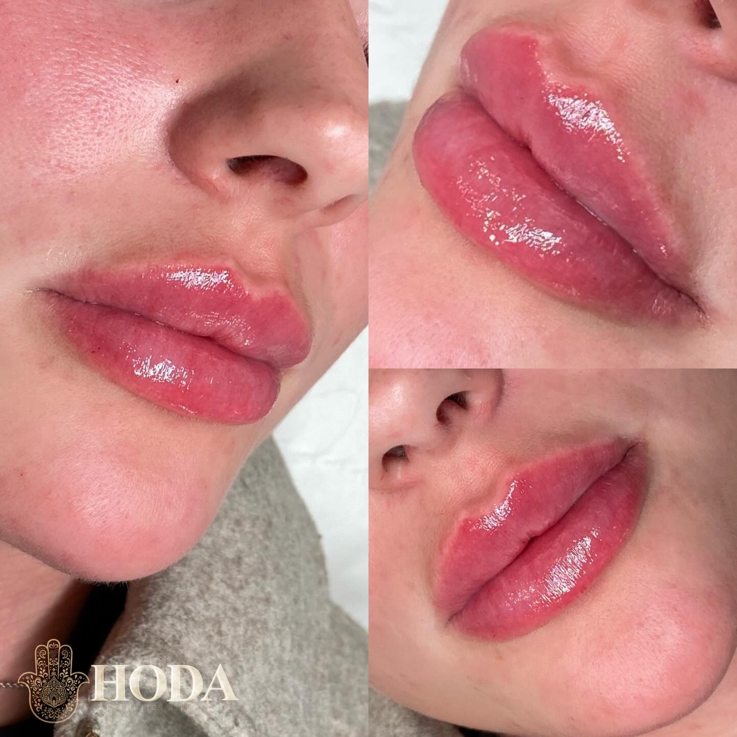 Absolutely loved creating this beautiful lip enhancement ๐๐
Swipe to see the before and after. The goal was to create more definition, shape and volume, especially around the cupidโs bow and lip border. The transformation really enhances the overall lip structure and gives a fuller, more defined look.
Lip filler is a great way to enhance lip shape and add volume while improving symmetry and definition.
๐ฒ DM book with Hoda
๐ฉ๐ผโโ๏ธ Nurse Led-Aesthetic Clinic
๐ Bournemouth, Dorset
#bournemouthaesthetics
#bournemouthlipfillers
#bournemouthbeauty
#bournemouthclinic
#dorsetaesthetics