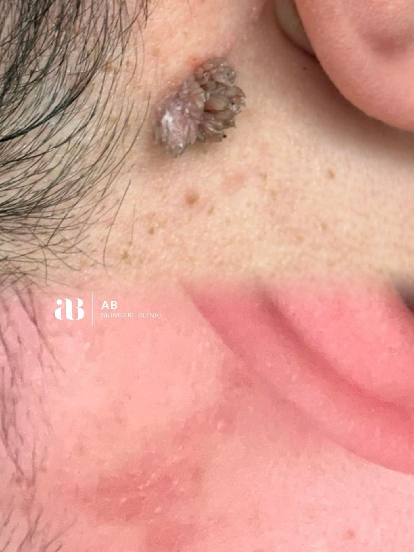 Not all warts are created equal 👀
Filiform warts are those finger-like growths that often pop up around the eyes, lips, or neck—and they can grow faster than you’d expect.
✨ The good news? They’re totally treatable.
With the right approach, you can go from stubborn and noticeable ➡️ smooth and clear.
This before & after says it all 🙌
If you’ve been ignoring one thinking it’ll go away on its own… it might be time to take action.
💬 Got questions about skin lesions? Drop them below or DM me!
#SkinCare #WartRemoval #FiliformWart #SkinHealth #skinclinictalbotgreen