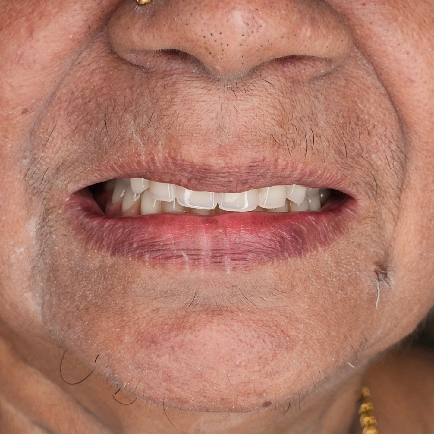 Removable Complete Dentures - the "easiest" way of full mouth rehabilitation.
Restoration of function , comfort , esthetics done for a 60 year young lady using IVOCLAR Biofunctional Prosthetic System.
#ivoclar #bps #denture #cd #prosthodontics #sethusdentalhouse