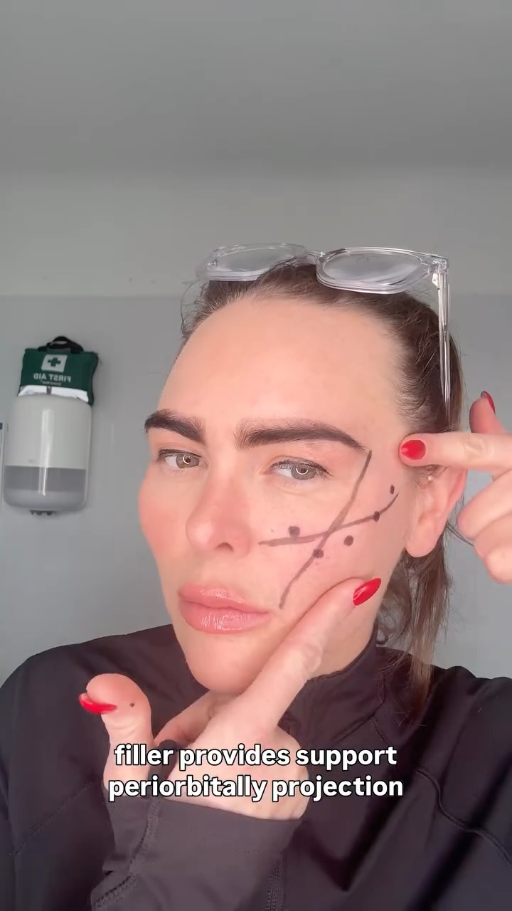 Mid-face vs lateral cheek filler… same treatment, different purpose.
• Mid-face → restores volume loss
• Lateral cheek → lifts and supports ligaments
• Correct placement = natural rejuvenation
Understanding facial anatomy and vector lifting is what separates average results from exceptional ones.
#aesthetictraining #aesthetic #aestheticclinic #skinclinic #antiaging