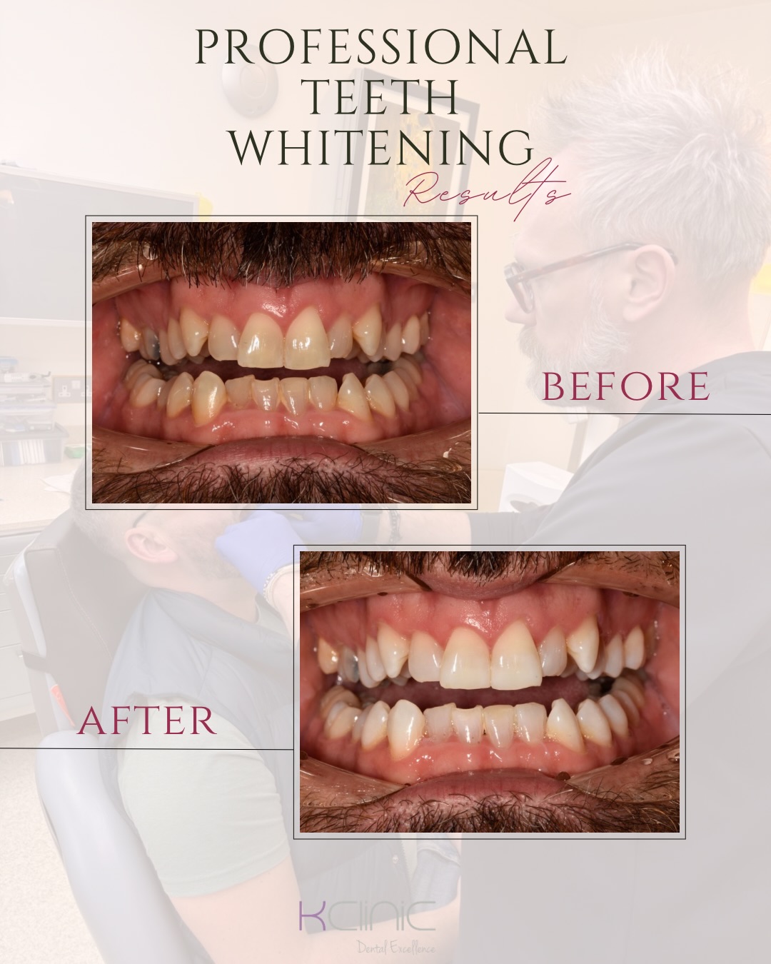 Teeth whitening transformation 🤍
Before ➡️ After
Our patient was the lucky winner of our Halloween giveaway and received a professional Riso whitening kit✨🏅
Just look at this amazing before & after transformation!
whitening kit.
The results speak for themselves – a brighter, more confident smile! 😍
Thinking about brightening your smile too?
Get in touch with K Clinic to learn more about our whitening options ✨🫶🏼
0 % Finance options available
📍7 Windsor Way, Knutsford WA16 6JB
🌐 www.kclinic.co.uk
📱 07946 219 539
☎️ 01565 653480
#smiletransformations#dentist#dentista#teethcare#teethwhitening