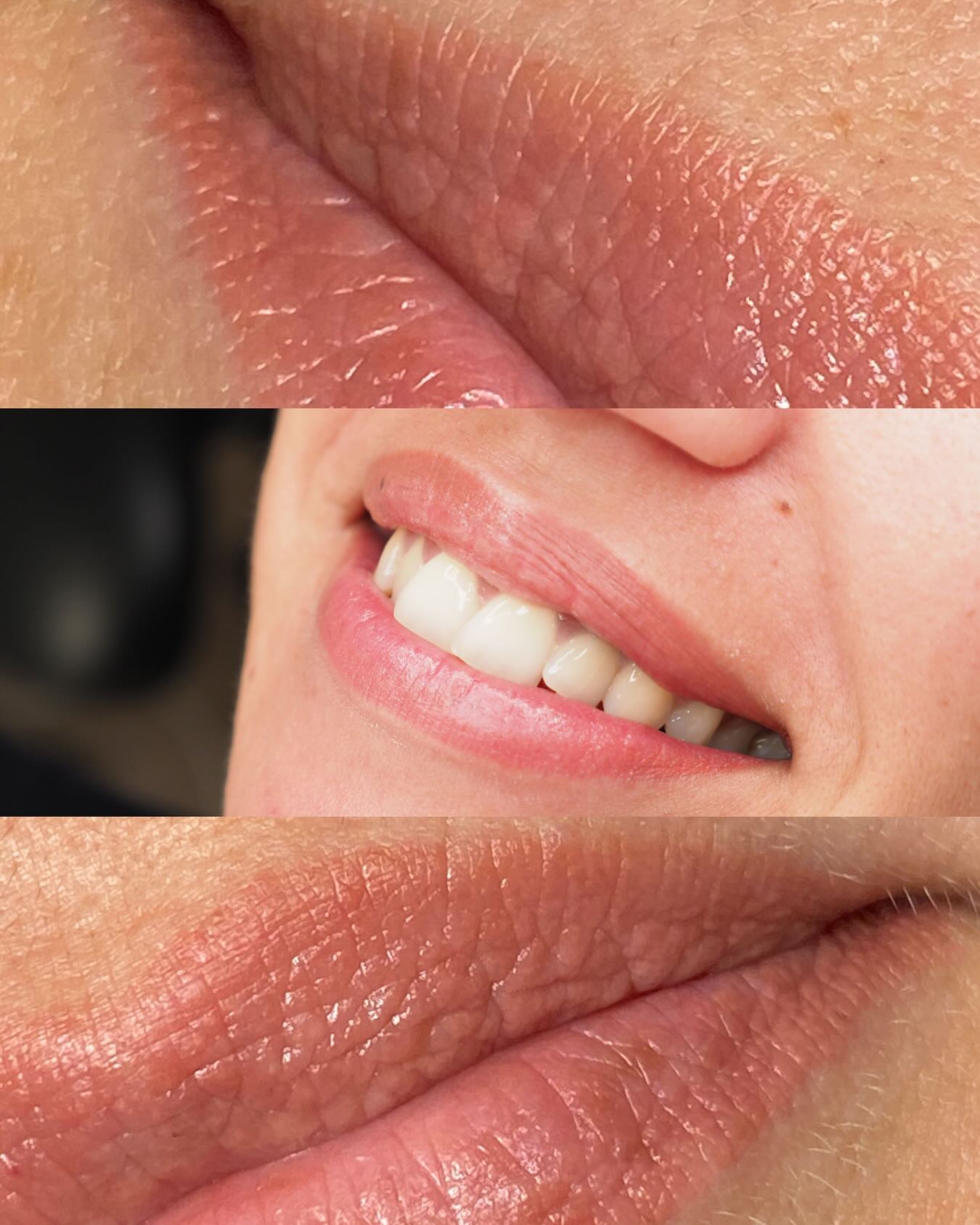 Des lèvres pâles, ternes ou irrégulières ?
La technique Candy Lips permet de raviver la couleur naturelle des lèvres, d’unifier la teinte et d’apporter un effet frais et lumineux au quotidien.
Grâce à la dermopigmentation, les lèvres paraissent plus définies, plus rosées et subtilement repulpées, tout en restant très naturelles.
Résultat :
✨ Effet bonne mine immédiat
✨ Couleur naturelle et personnalisée
✨ Lèvres sublimées sans maquillage
✨ Tenue longue durée
Réveillez la beauté naturelle de vos lèvres et profitez d’un sourire lumineux chaque jour.
📩 Réservation en message privé