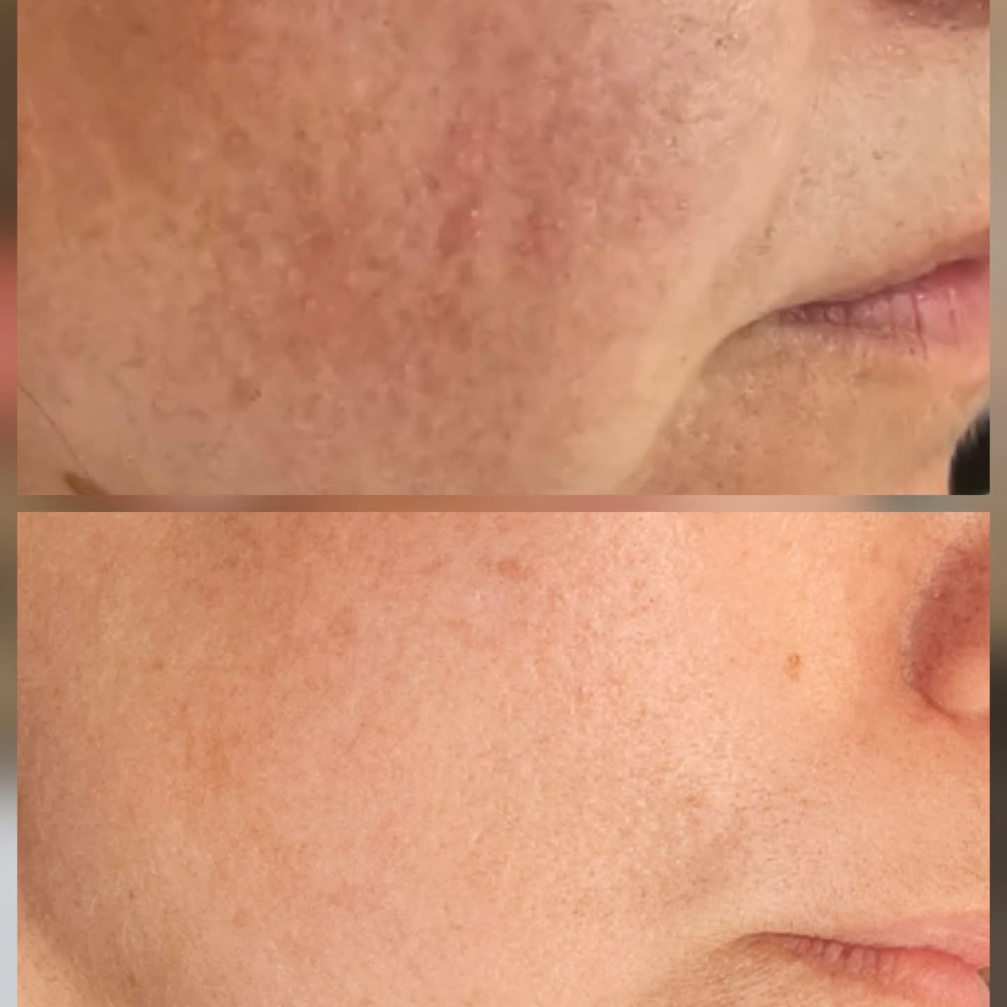 Treating Keratosis Polaris using homecare and THE MASK.
@thepowderroom_by_ginene