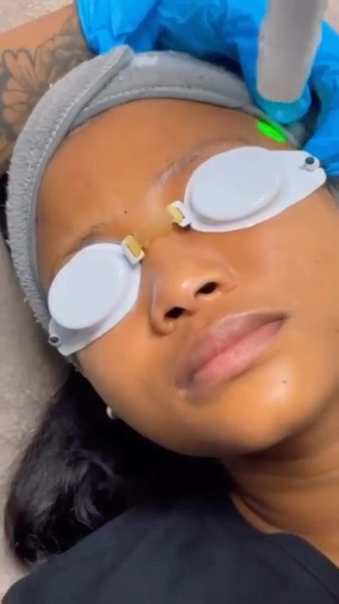 DEKA - What’s the Hype About
Deka is a professional dual-wavelength laser platform used to treat a range of aesthetic skin issues - including skin rejuvenation.
It uses both Alexandrite (755 nm) and Nd:YAG (1064 nm) laser wavelengths to deliver energy into the skin.
🌟 Key Features ✔ Dual wavelength system: • Alexandrite is effective on superficial targets. • Nd:YAG penetrates deeper into the skin.
This combo enables a versatile approach to skin texture and tone.
✔ Moveo Technology: This DEKA-exclusive contact technique lets the laser deliver heat more evenly and with less reflected energy - meaning enhanced comfort and safety, including darker or tanned skin types.
✔ Multiple applications: Apart from skin rejuvenation, Again is also used for hair removal, vascular lesion treatment, and pigmented lesions - but the Moveo SR setting specifically targets rejuvenation by stimulating collagen production deep in the dermis.
🧴 What It Does for the Skin 📌 Collagen stimulation & tightening – Controlled heat stimulates neocollagenesis (new collagen creation).
📌 Improves skin texture & firmness - Leads to smoother, more resilient skin.
📌 Treats all skin types, including darker or tanned skin (Fitzpatrick I–VI). 📌
Little to no downtime – Often described as a “lunchtime rejuvenation” because you can resume normal activities soon after treatment