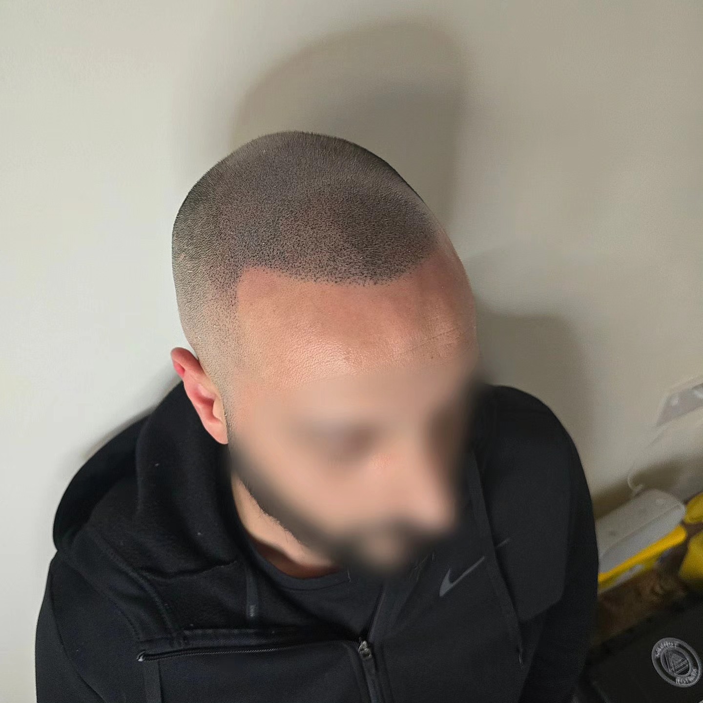 T H E P R O C E S S
SWIPE ALONG FOR THE PROCESS
HUGE TRANSFORMATION
Scalp Micro-Pigmentation (SMP) is a cosmetic tattoo to disguise hair loss, creating the ultra realistic replication of hair follicles to create the look of a full head of hair
At the highest level, SMP is so hard to distinguish from real shaved hair
The process (For full head):
✔️First session: Shave head, design and create hairline, SMP to create a base
✔️Second session to build more realistic density and depth
✔️Third session for more density and ensure all areas covered sufficiently
Typically completed over 3 sessions, with around 10 days between
*Density treatments slightly differ
📍Bury St Eds
#scalppigmentation #hairtattoo #hairloss #buzzcut #hairgrowth #hairtransplant #hairlosssolution #scalptattoo #cosmetictattoo #mensmentalhealth #confidence #menshair #barber #tattoo #menshairideas #smp #hairtransformation
#bald #balding #recedinghairline