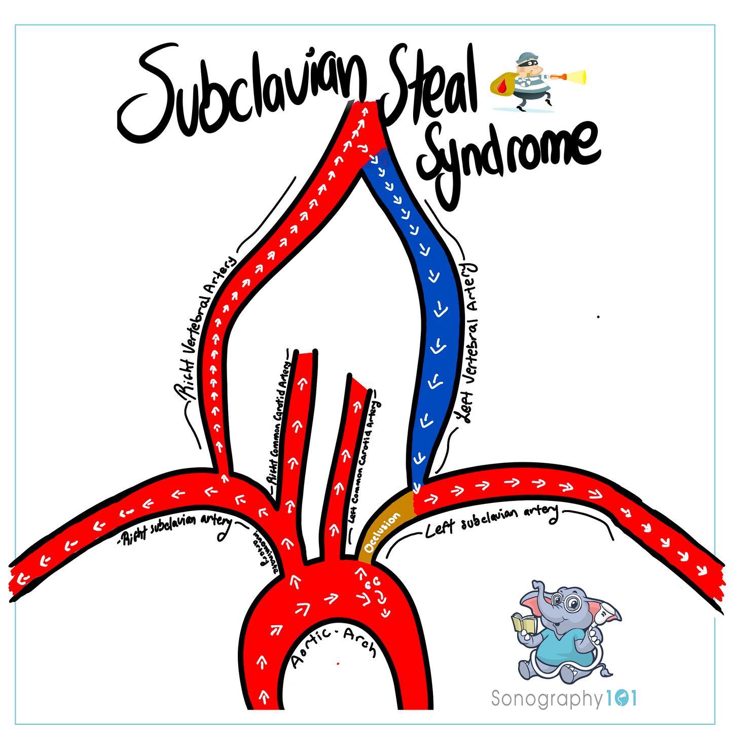 I hope everyone has had a fantastic weekend! 🤗As promised here’s a little intro on the requested topic: Subclavian Steal Syndrome!
All in all what is occurring in this syndrome is that due to a stenosis or an occlusion in the subclavian artery the ipsilateral (same side) vertebral artery is serving as a collateral to continue to provide blood flow to the upper extremity. Due to this, often times your patients will present with neurological symptoms, (as blood flow is being stolen from the brain) and this finding will often be found during a carotid ultrasound, so always be extra cautious with your vertebral images 🤗 or if you’re doing an ABI (since you have to get both brachial pressures) this could be an incidental finding. Remember a change of 20mmhg or more from one brachial to another is abnormal. This doesn’t confirm subclavian steal but it shows there’s something going on, and the patient will be referred for an upper extremity ultrasound of the arm with the lowest pressure, or both (to be safe).
I hope this helps! If you have any questions or need further help on this topic, don’t hesitate to comment or DM us 🤗❤️
P.S. if you’re having difficulty determining direction of flow, a quick “trick”, is showing a dual screen of the carotid artery and the vertebral artery, while in the same plane and without adjusting the color, if normal, both should appear in the same color, (as they’re both taking blood up to brain), if abnormal they will not appear the same.
.
.
.
.
#ultrasound #sonography #medicalsonography #RDMS #RVT #RegisteredDiagnosticMedicalSonographer #RegisteredVascularTechnologist #UltrasoundTechnologist #Sonographer #UltrasoundTech #Sonography101 #ultrasoundED #ultrasononography #ultrasonographer #Medicine #Medical #Radiology #Radiologia #Ultrasonido #DiagnosticImaging #Medicina #Sonograma
#sonographystudent #sonographyschool