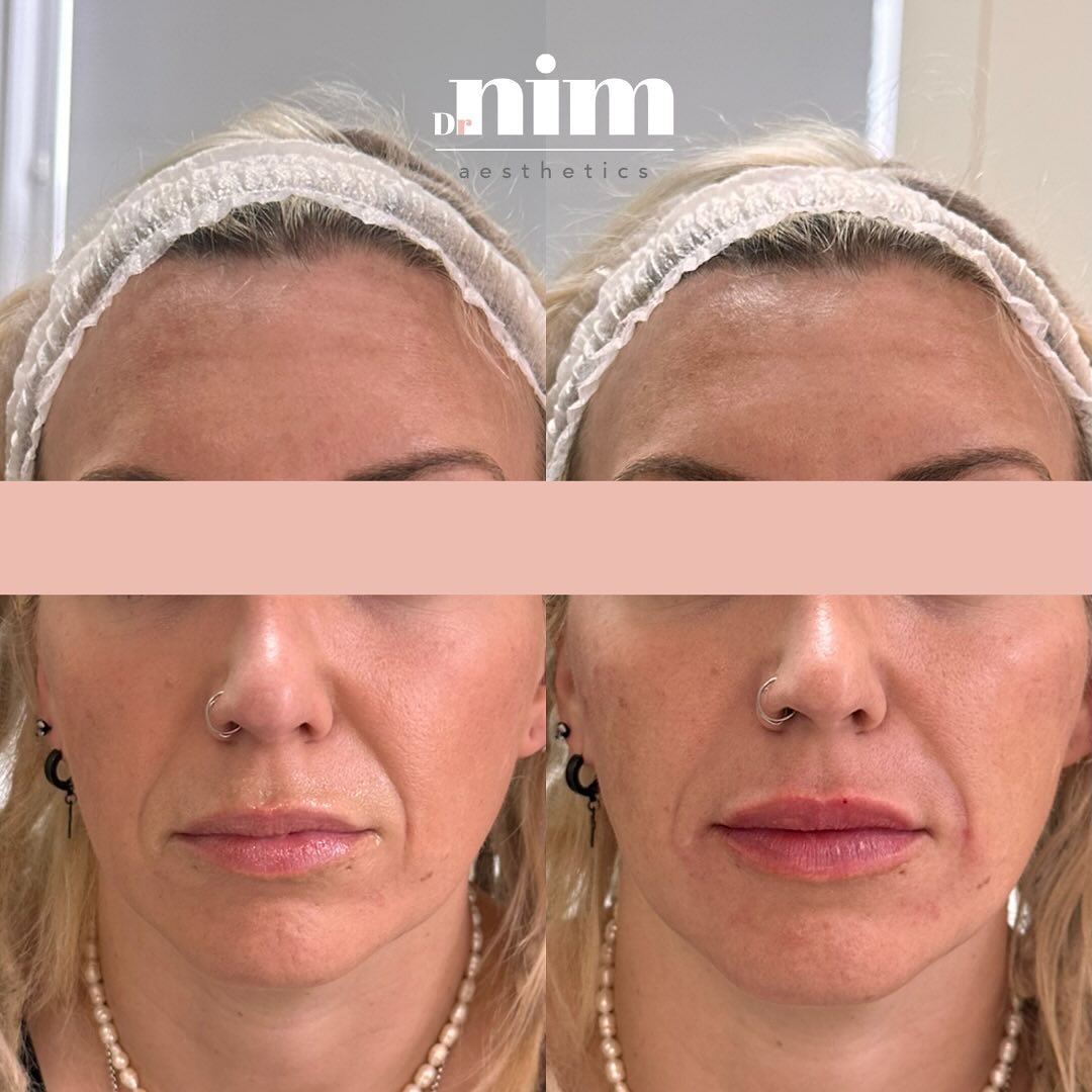 FULL FACIAL BALANCING
We are loving these results for our lovely patient! 😍 She had just started to notice the early signs of ageing and wanted treatment so she felt fresher and looked more youthful.
To accomplish this, we focused on treating the entire face. This is what we call "full facial balancing," which harmonises all your features simultaneously.
We strategically place fillers in multiple areas rather than just one, resulting in a refreshed appearance while maintaining your natural look.
It’s subtle; you wouldn’t guess this client has had any enhancements! 😉
What a gorgeous transformation 🤩