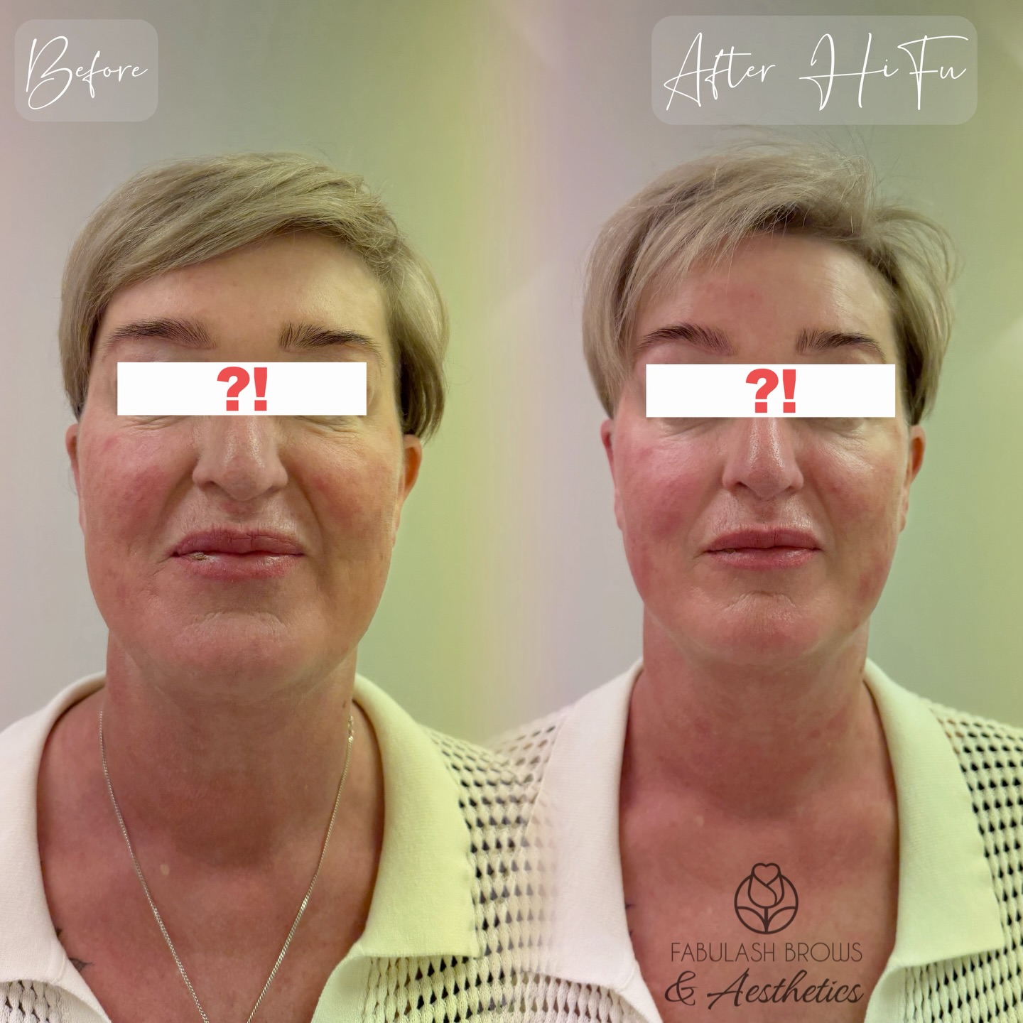 💁♀️Here she comes!!!! Third year getting Special HIFU tightening with us! This is instant result after the treatment !💯💯💯💪
❌Don’t forget we have MARCH SPECIAL $100 OFF applied for all face and body areas!🤩🤩!