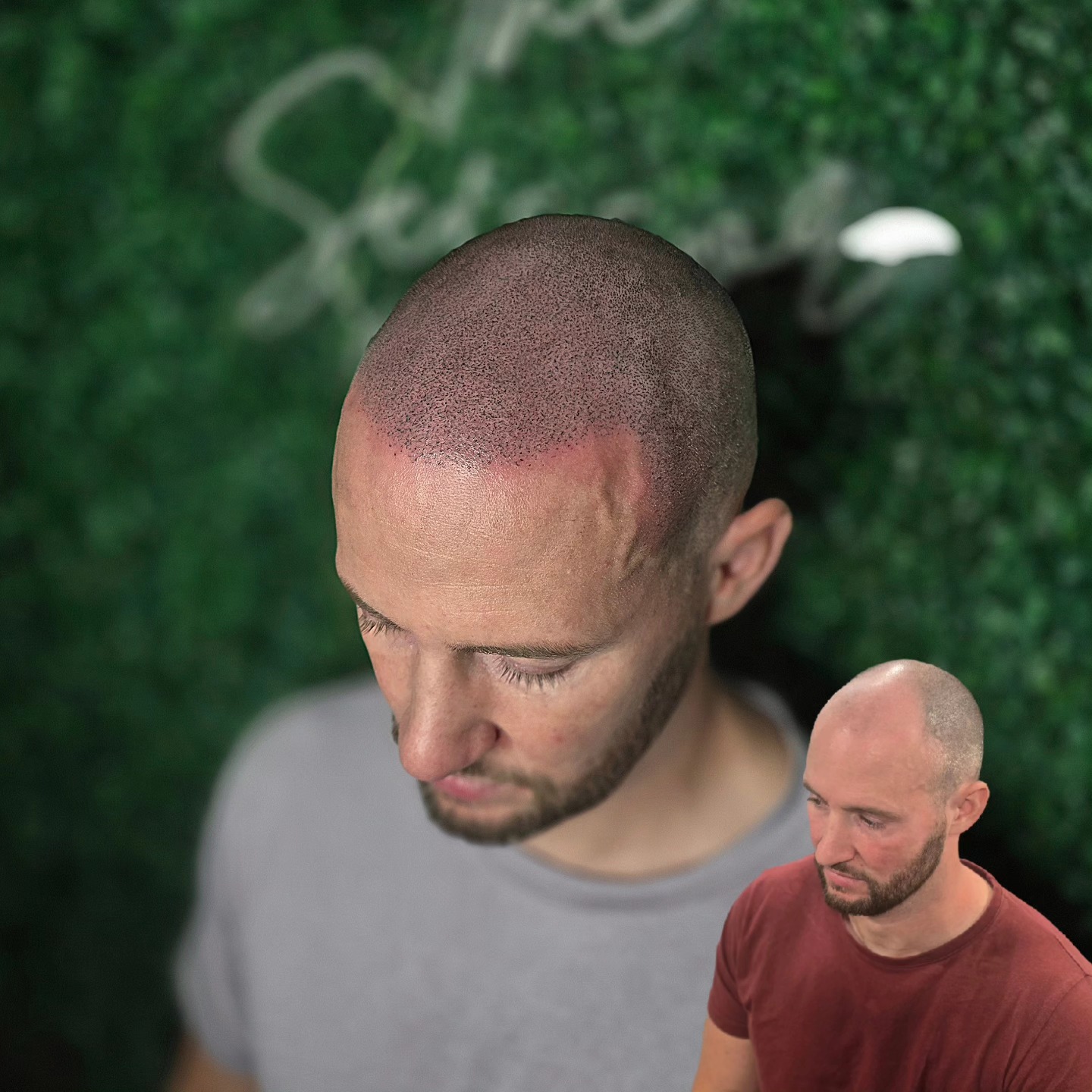 SMP TRANSFORMATION
Scalp Micro-Pigmentation is the only hair loss treatment with guaranteed results!
Cosmetic tattooing with the finest details for the most realistic results!
Enquire now to see how SMP can help you solve your hair loss!
- Far more cost effective hair loss than other hair loss solutions
- Non-invasive, no surgery
- No medication
- Minimal to low maintenance
📍Bury St Edmunds, Suffolk
#smp #smpartist #hairtattoo #hairlosssolution #hairlosstreatment #scalppigmentation #scalpmicropigmentation