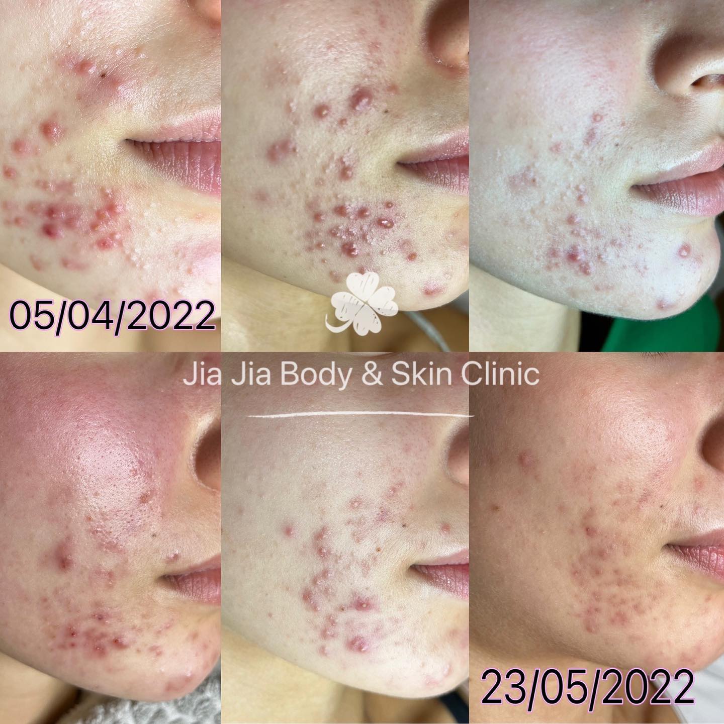 6 acne treatments within 7weeks
#jiajiabodyandskinclinic #clearskin #herbalaktivpeel #lasertreatment #sgaacnetreatment #bpeel #drspiller #alexcosmetic #phytopeel #gooddiet