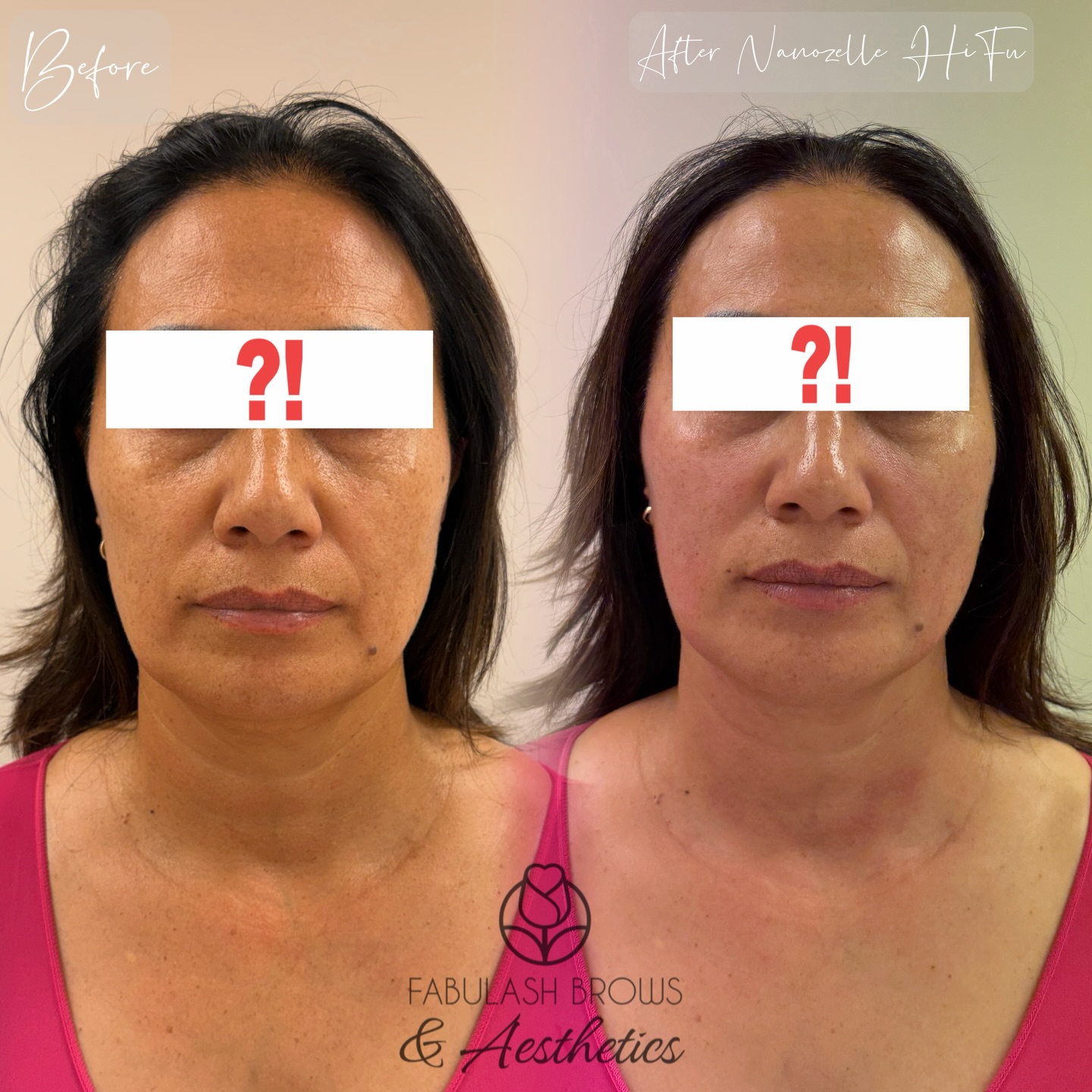 💁♀️💁♀️ HIFU Skin Tightening – The “Quiet” Anti-Ageing Treatment
One thing I always tell my clients about HIFU is this: it’s not a treatment that will suddenly change your face overnight. The results depend a lot on each person’s bone structure, skin condition, and level of ageing. For some people the lift is more visible, while for others it is more subtle.
But what HIFU really does is tighten the skin from deep inside by stimulating your natural collagen. Your skin gradually becomes firmer, smoother and more lifted over time.
The best part?
People often say you look fresher, tighter and younger… but they can’t quite tell what you’ve done. 😉
That’s the beauty of HIFU — natural results, no drastic change, just a better version of you.
✨ If you’re looking for a non-surgical way to maintain youthful skin, HIFU might be the perfect treatment for you.
#hifufacelifting #skintighteningtreatment #nz #hifufacial #hifu