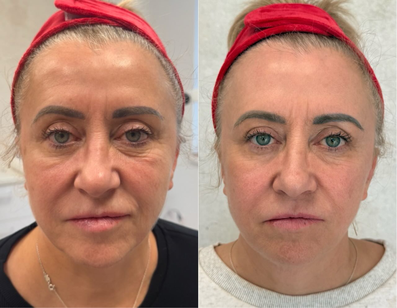 To jest ten efekt, który zawsze cieszy nas najbardziej, bo on nie krzyczy.
Tak wygląda skóra, która dostała właściwy bodziec i czas na przebudowę.
U naszej Pacjentki wykonaliśmy serię naszej bestsellerowej procedury Light&Bright, a to efekt po dwóch miesiącach od drugiego zabiegu. 🫶
To nie są zabiegi „na już”. To jest proces, który z miesiąca na miesiąc pokazuje, że skóra może wyglądać młodziej, bo poprawia się jej jakość: gęstość, napięcie, sprężystość i świeżość.
To są zabiegi, które nie robią „nowej twarzy”. One przywracają skórze to, co czas zabiera i wzmacniają ją na przyszłość. 👌
Zapraszamy 🤍
693-101-233
