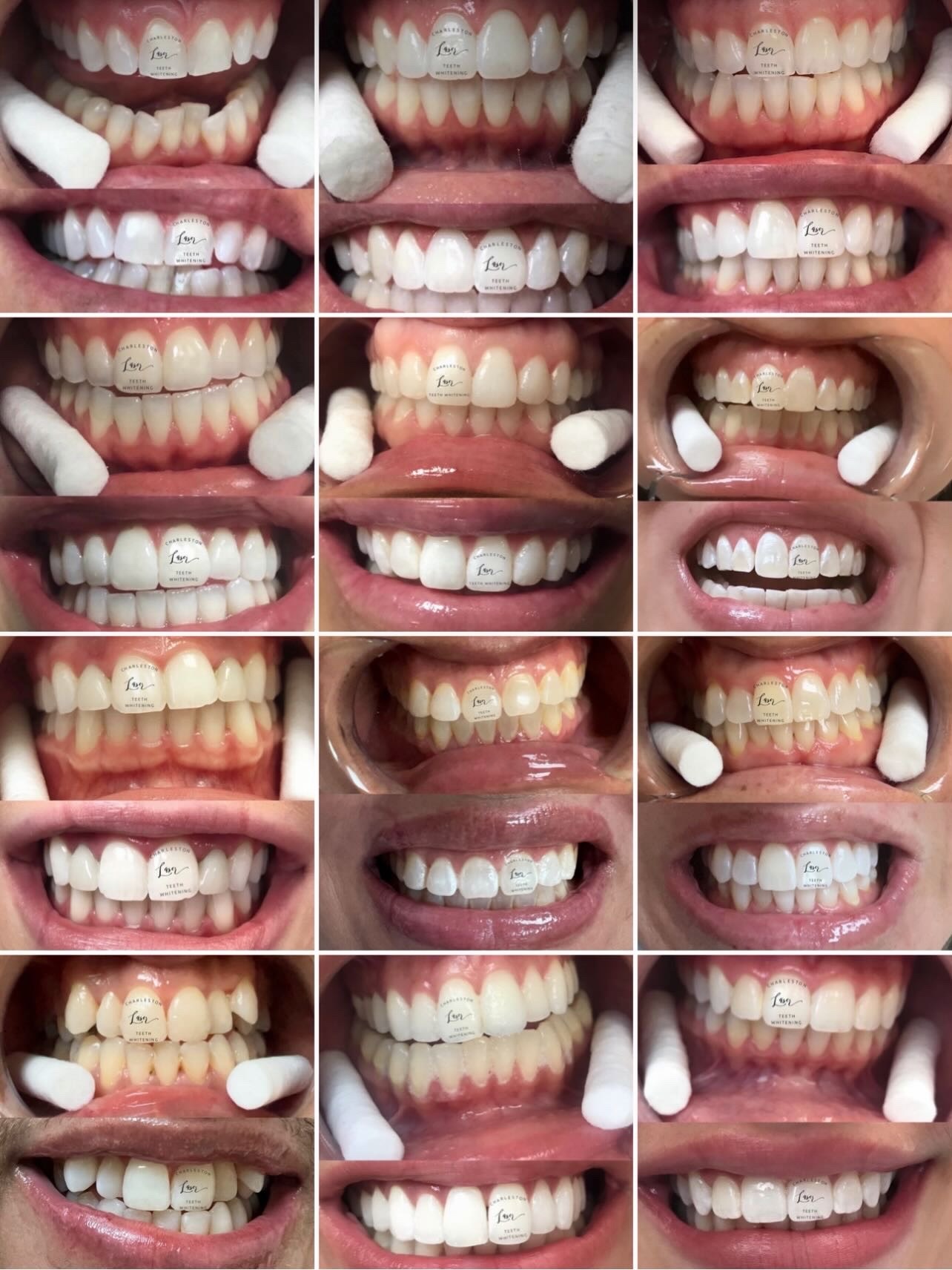 Freshly whitened teeth have a funny side effect:
you start noticing how young your smile still is. 🤸♀️✨
Book your teeth whitening now!
www.CharlestonLaserTeethWhitening.com
#teethwhitening #charlestonteethwhitening #charleston #charlestonsc #charlestonlaserteethwhitening mountpleasant mountpleasantsc kiawahisland kiawahjamesisland westashley isleofpalms downtowncharleston sullivansisland johnsisland johnsisland northcharleston northcharlestonsc folly follybeach laserteethwhitening