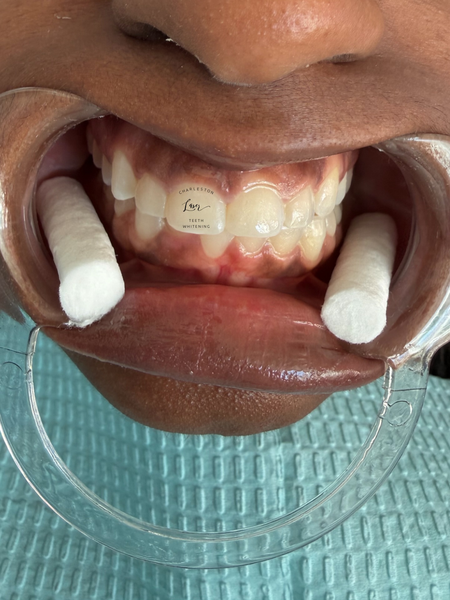 Swipe 👉 to see the results from a 1 Hour Teeth Whitening this week!
Book your teeth whitening now!
www•CharlestonLaserTeethWhitening•com
#teethwhitening #charlestonteethwhitening #charleston #charlestonsc #charlestonlaserteethwhitening mountpleasant mountpleasantsc kiawahisland kiawahjamesisland westashley isleofpalms downtowncharleston sullivansisland johnsisland johnsisland northcharleston northcharlestonsc folly follybeach laserteethwhitening