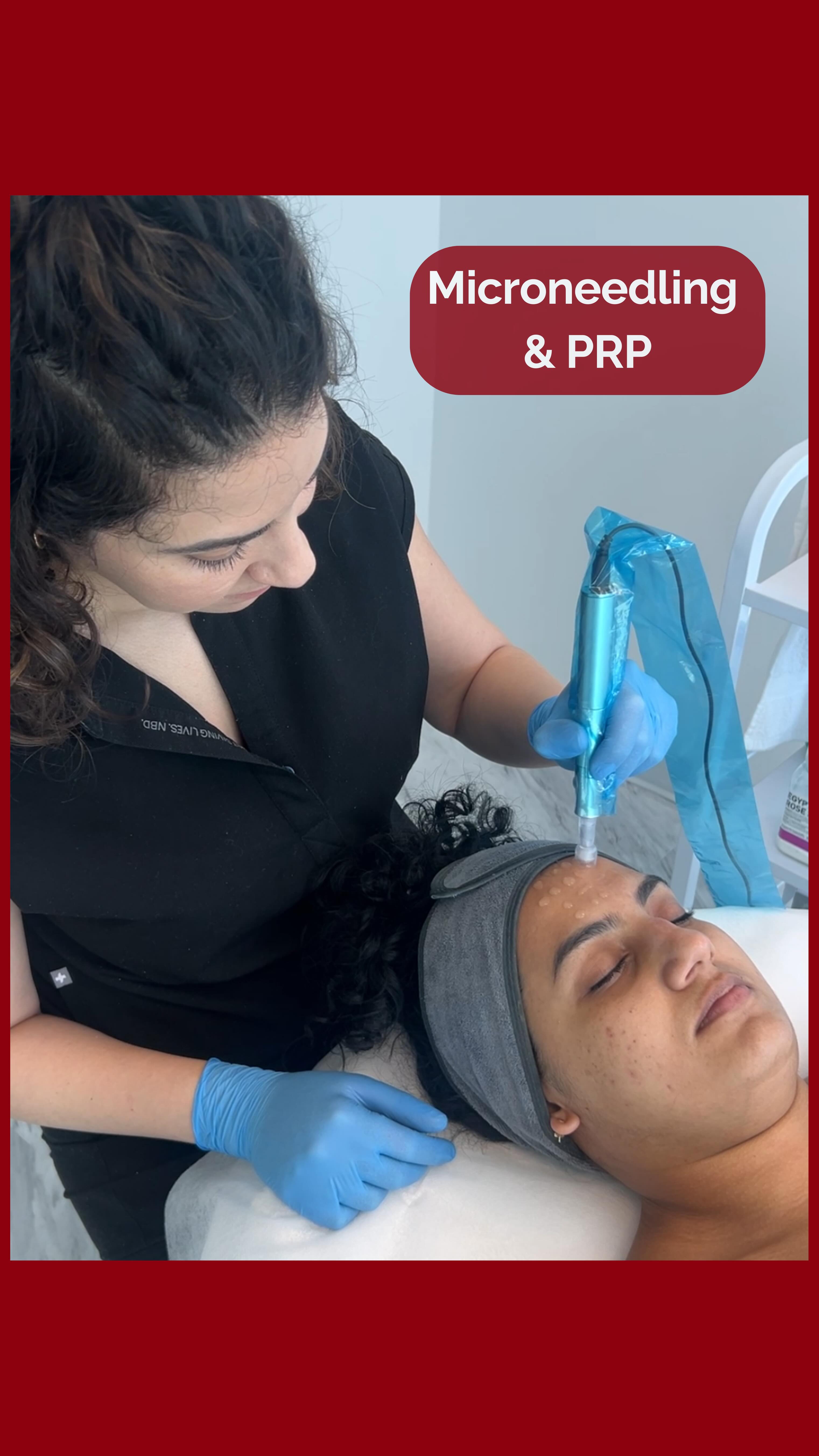 Everyone loves the idea of glowing skin 🥰
But what most people actually want is skin that feels stronger, smoother, and more even without heavy makeup or filters.
Microneedling with PRP is one of those treatments that quietly does the work in the background. It uses your body’s own repair system to rebuild collagen over time, which is why the results look natural and keep improving 📈
If you’re tired of surface-level fixes and want something that actually improves your skin quality, this is worth considering.
Come in for a consultation and we’ll see if it’s right for you!
📍 4141 Yonge St, Unit 304, Toronto, ON M2P 2A6
📞 (416) 481-2888
📩 info@redwoodmedispa.com
#microneedling #prp #collagen #acnescars #skintightening