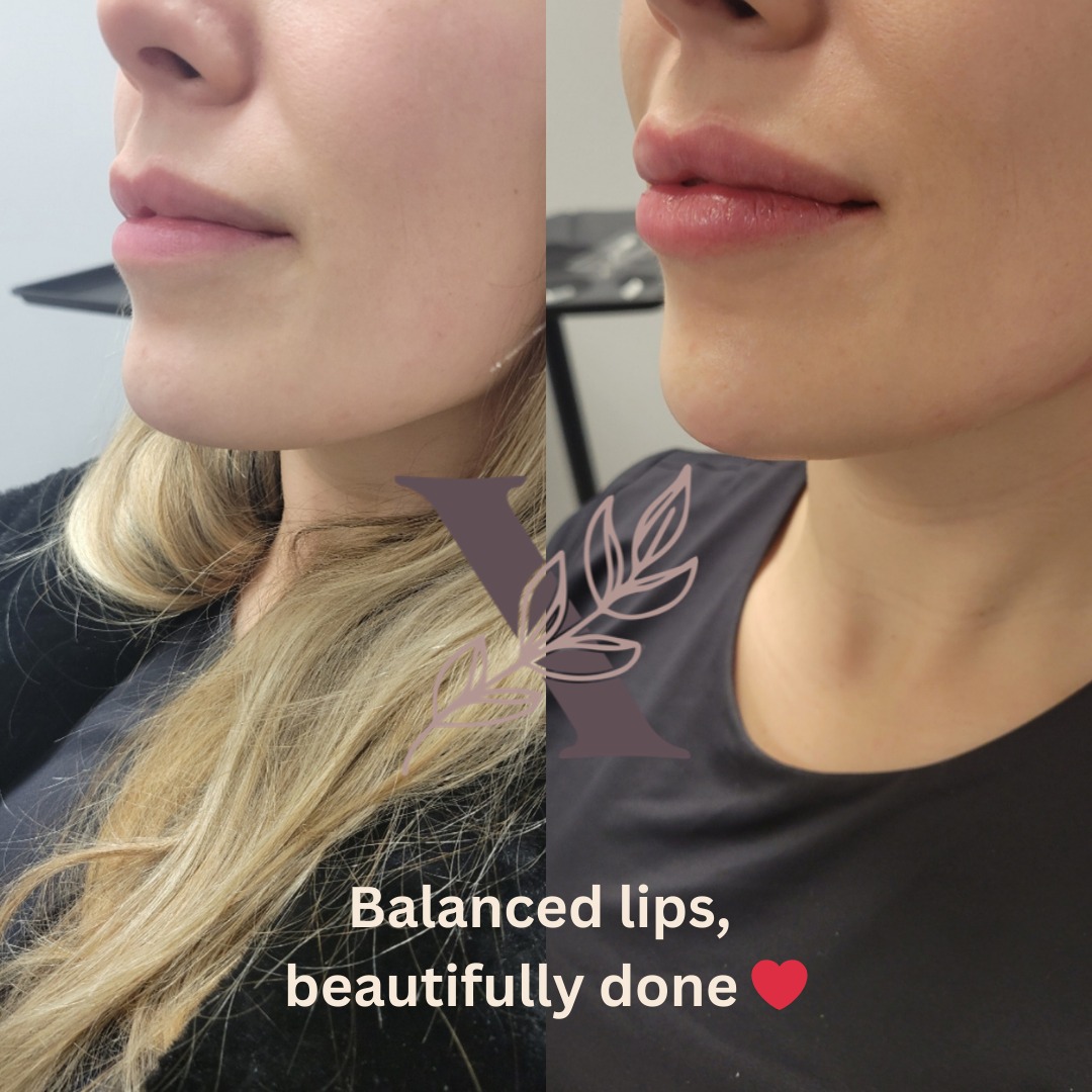 One of my lovely students, Anna, assisted me with these lips during her Transition-to-Practice Mentorship clinical day 💋✨
Hands-on clinical experience is such an important part of building confidence, refining technique, and learning how to approach each set of lips with both safety and artistry in mind. So proud to be part of her journey as she continues to grow in aesthetic practice 🤍
#LipFiller #AestheticTraining #NurseInjectorTraining #LipEnhancement #MedicalAesthetics #BeautyXpressionsAcademy #InjectorMentorship #AestheticMedicine #OttawaAesthetics #WindsorAesthetics