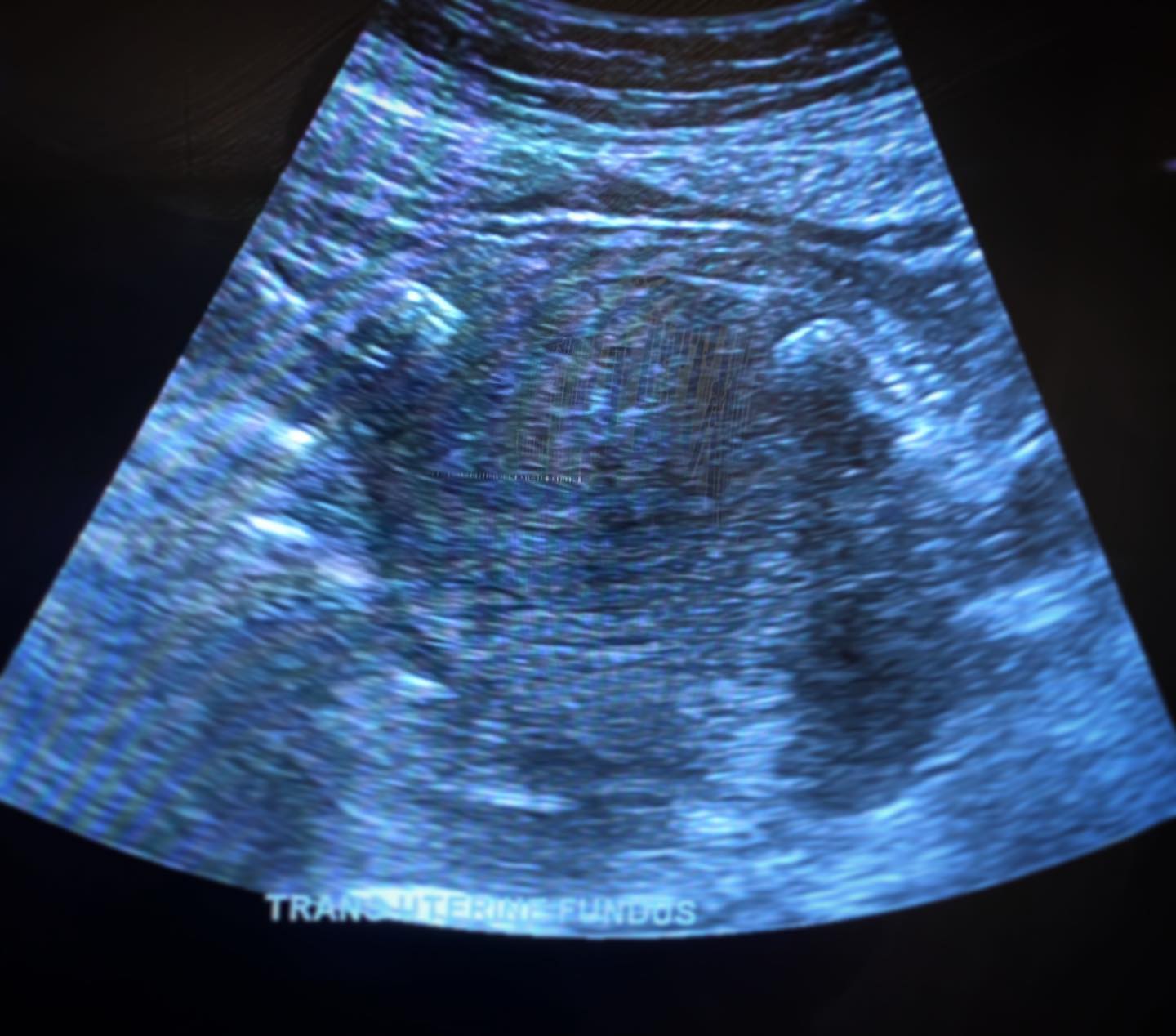 Essure Device, do you guys see it? I swear all I see is a little snake (well, two little snakes if we want to be technical lol) 🐍 🤷🏻♀️😂 😁
I hope everyone is doing well and staying safe, as we get back to “normal” 😅🤗❤️