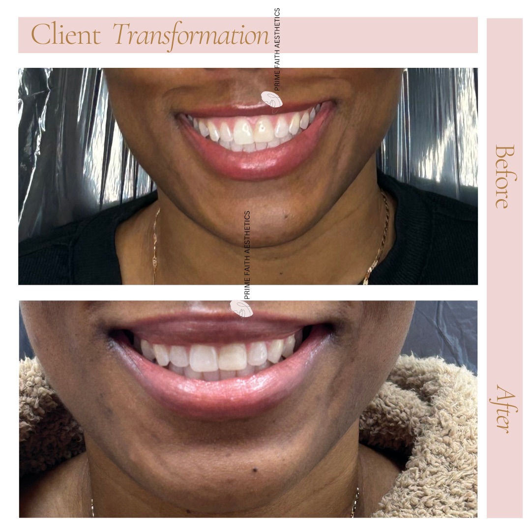 One of my favorite beauty secrets: the lip flip! 💋 Just a little Tox goes a long way in helping to reduce that gummy smile, giving you a more balanced and natural look. It’s a simple yet effective treatment that enhances your natural beauty!
If you’ve always wanted to try a lip flip, now’s your chance! Book your consultation today through the link in my bio! 👄#LipFlip #BeautySecrets #GummySmile #NaturalBeauty #dallastx