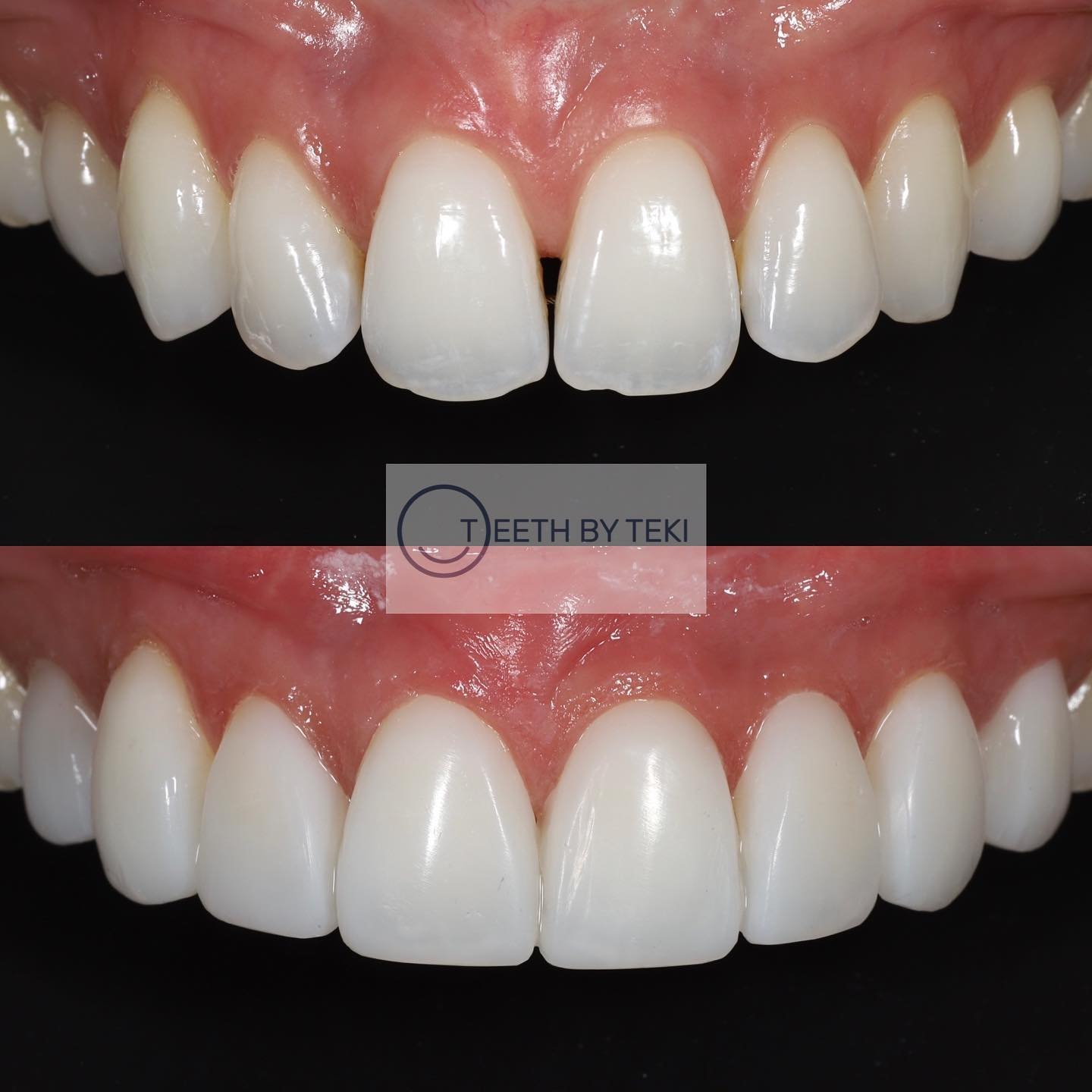 No one is perfect. Just try to be better 💙
.
.
Composite bonding on 8 teeth
.
.
Prices and more info on website
.
.
To book please email book@teethbyteki.com
.
.
#teethbyteki