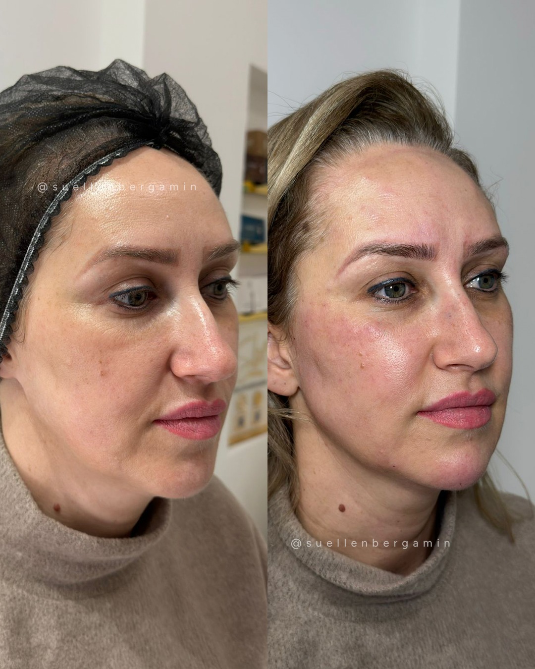 Que linda!! 😍😍😍
Neste resultado, a paciente realizou harmonização facial associada à aplicação de botox, uma combinação que ajuda a valorizar os traços e deixar o rosto com aparência mais leve e descansada.
Enquanto a harmonização melhora contornos e proporções do rosto, o botox atua suavizando linhas de expressão, especialmente na testa, entre as sobrancelhas e ao redor dos olhos.
O resultado é um rosto mais harmônico, rejuvenescido e natural.
📲 Agende seu horário: 📲+44 7398 192413
.
How beautiful!! 😍😍😍
In this result, the patient underwent facial harmonization combined with a botox application — a combination that helps enhance facial features and leave the face looking lighter and more refreshed.
While facial harmonization improves the contours and proportions of the face, botox works by softening expression lines, especially on the forehead, between the eyebrows, and around the eyes.
The result is a more harmonious, rejuvenated, and natural-looking face.
📲 Book your appointment: 📲 +44 7398 192413