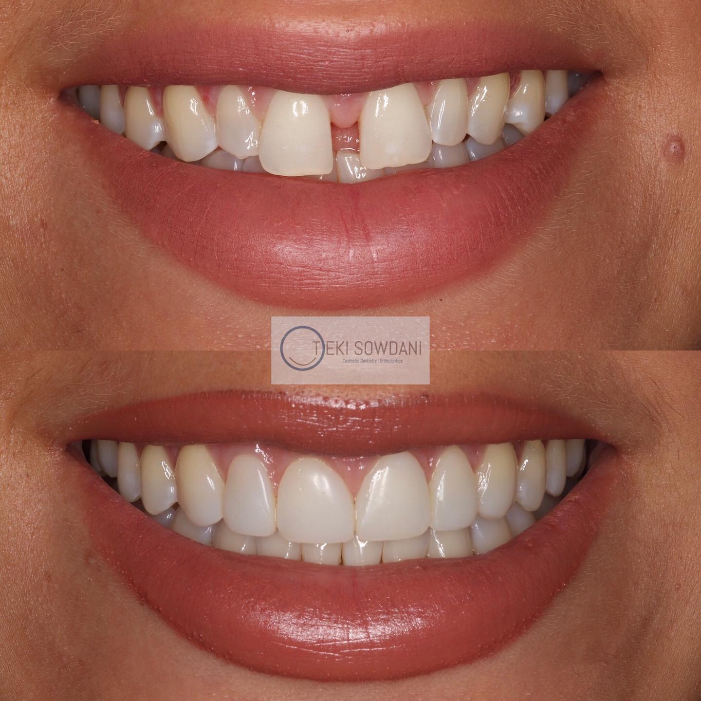It’s the combination that’s powerful .
.
You only get results like this with
INVISALIGN+COMPOSITE BONDING
.
.
#teethbyteki #invisalign #compositebonding