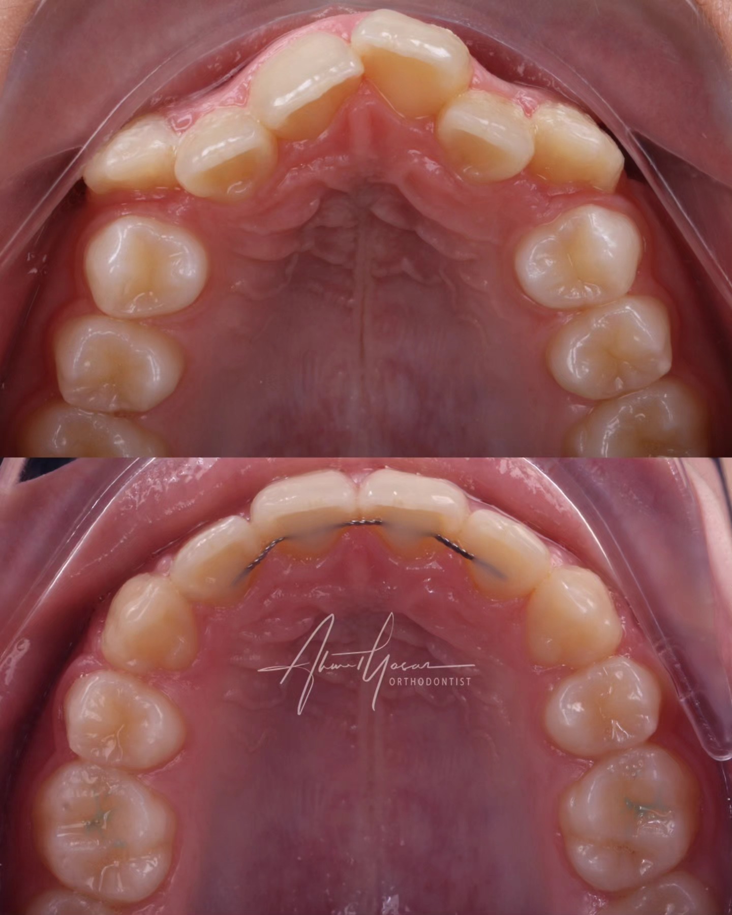 An upper first premolar extraction case.
.
Küçükazı dişi çekimiyle uygulanan bir ortodontik tedavi.
.
Our clinic is authorized by the Ministry of Health of the Republic of Türkiye for International Health Tourism. All patients have been informed and have provided consent for the use of their photographs on our social media platforms. All content shared on social media is intended to inform patients about procedures and should not be perceived as advertising. Outcomes of any surgical or interventional treatment may vary from person to person. It is recommended to consult your physician for detailed information before undergoing any procedure.
.
.
#ortodonti #ortodontist #bursa #bursaortodonti #bursaortodontist #bursaortodontiuzmanı #orthodontics #braces #teltedavisi #dişteli #orthognathicsurgery #invisalign #clearcorrect #şeffafplak #lingualortodonti #dişteli #çeneameliyatı #selfligating #kapaklıbraket #gülüştasarımı #dent #dentistry #photography #estetik #dentalart #ahmetyasar #drahmetyasar
