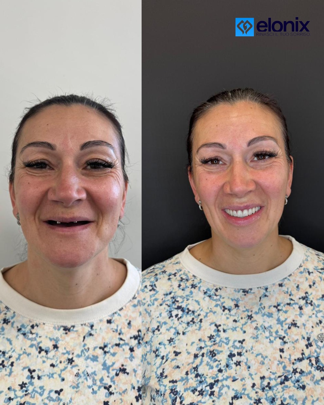 #elonix #elonixdentalclinic #elonixclinic #chiurgiamaxillofacciale #elonix #elonixdentalclinic #elonixclinic #chiurgiamaxillofacciale #clinica #elonix #estetica #salute #denti #dentista #impianti #turismodentale #turismodentalealbania #turismodentaletirana #turismodentaletiranaalbania #zircone #tirana #dentalsurgery #dentalveneers #dentalwork #laboratoriodentale #panoramica #scaner3d🦷 #dentifissi #sorriso #dentalsolutionsisrael #dentistica #sorridere