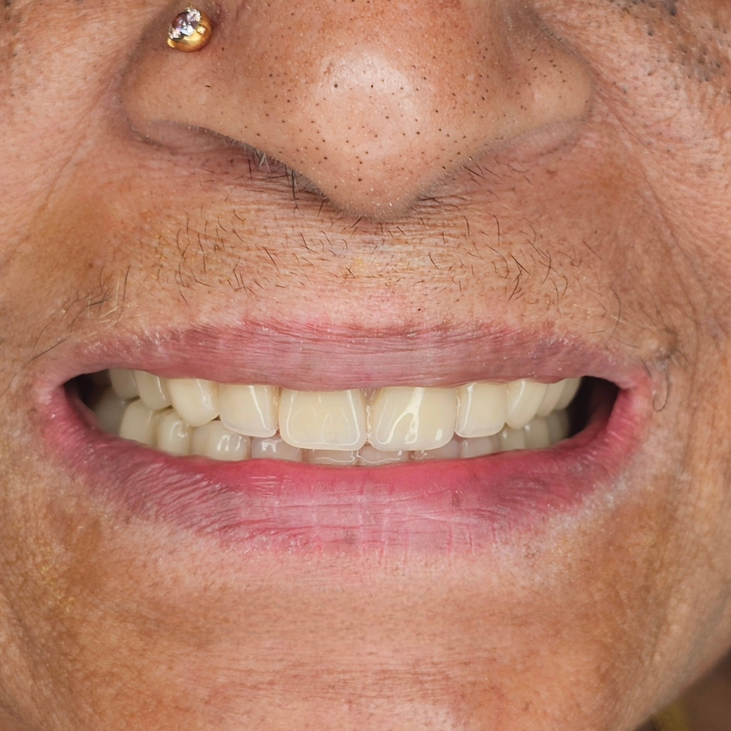 Beauty is a flower which wrinkles devour. But with help of artificial teeth we can inturn make those wrinkles vanish. Smile transformation of a beautiful strong lady which is clearly evident from before and after pics of her smile with and without the artificial teeth in place and function.
#dentures #denture #completedenture #dentistry #prosthodontics #sethusdentalhouse