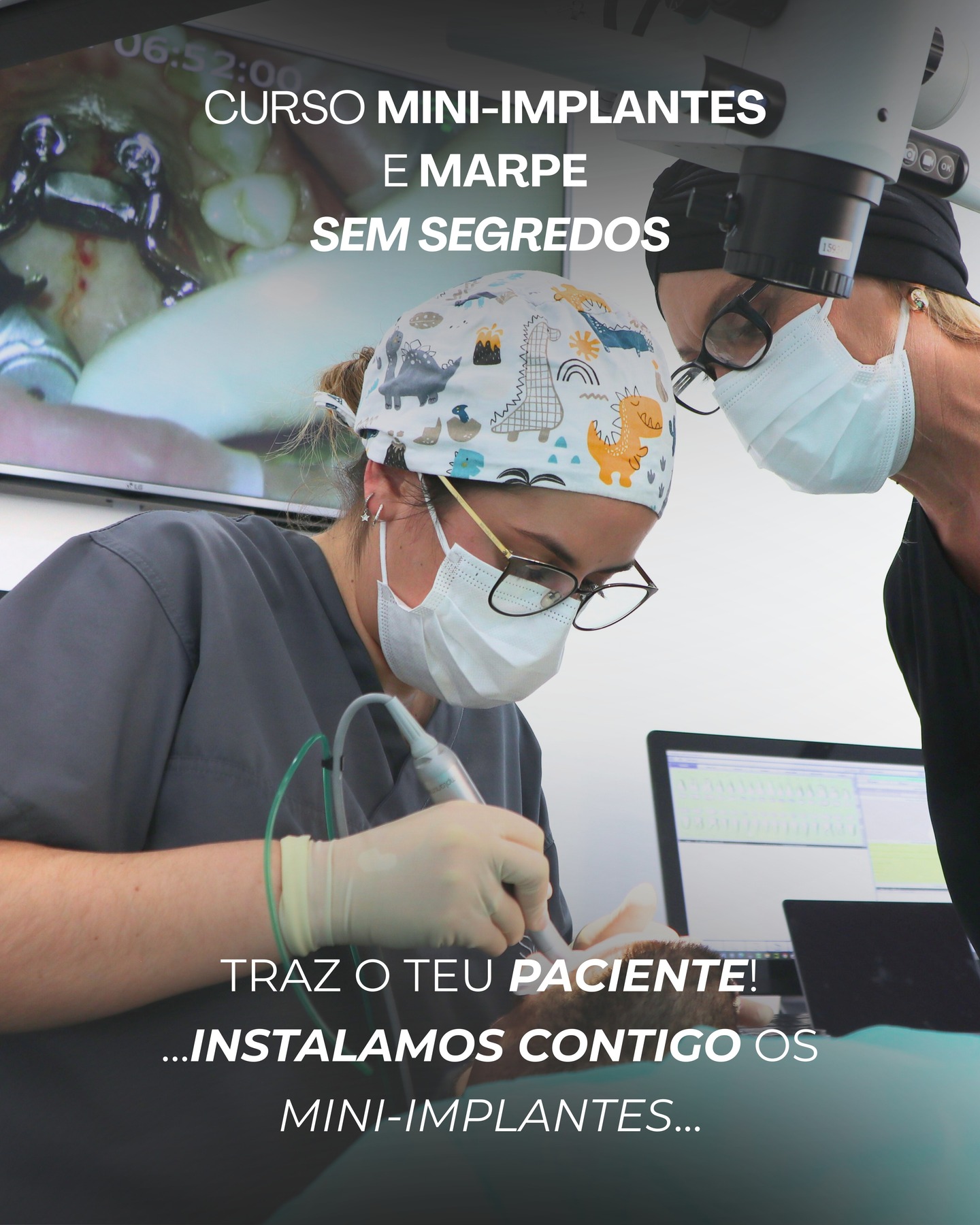 🦷 Traz o teu próprio paciente para o curso
No Mini-implantes e MARPE Sem Segredos, queremos que saias não apenas com conhecimento — mas com verdadeira experiência clínica.
Por isso, tens a possibilidade de trazer um paciente teu para instalar mini-implantes durante o curso, com planeamento prévio e acompanhamento direto das formadoras.
É uma oportunidade única para:
✔ aplicar a técnica num caso real
✔ discutir o planeamento clínico
✔ realizar a instalação com orientação passo a passo
✔ ganhar confiança para replicar depois na tua clínica
📅 16, 17 e 18 de abril
👉 Mais informações no link da bio.