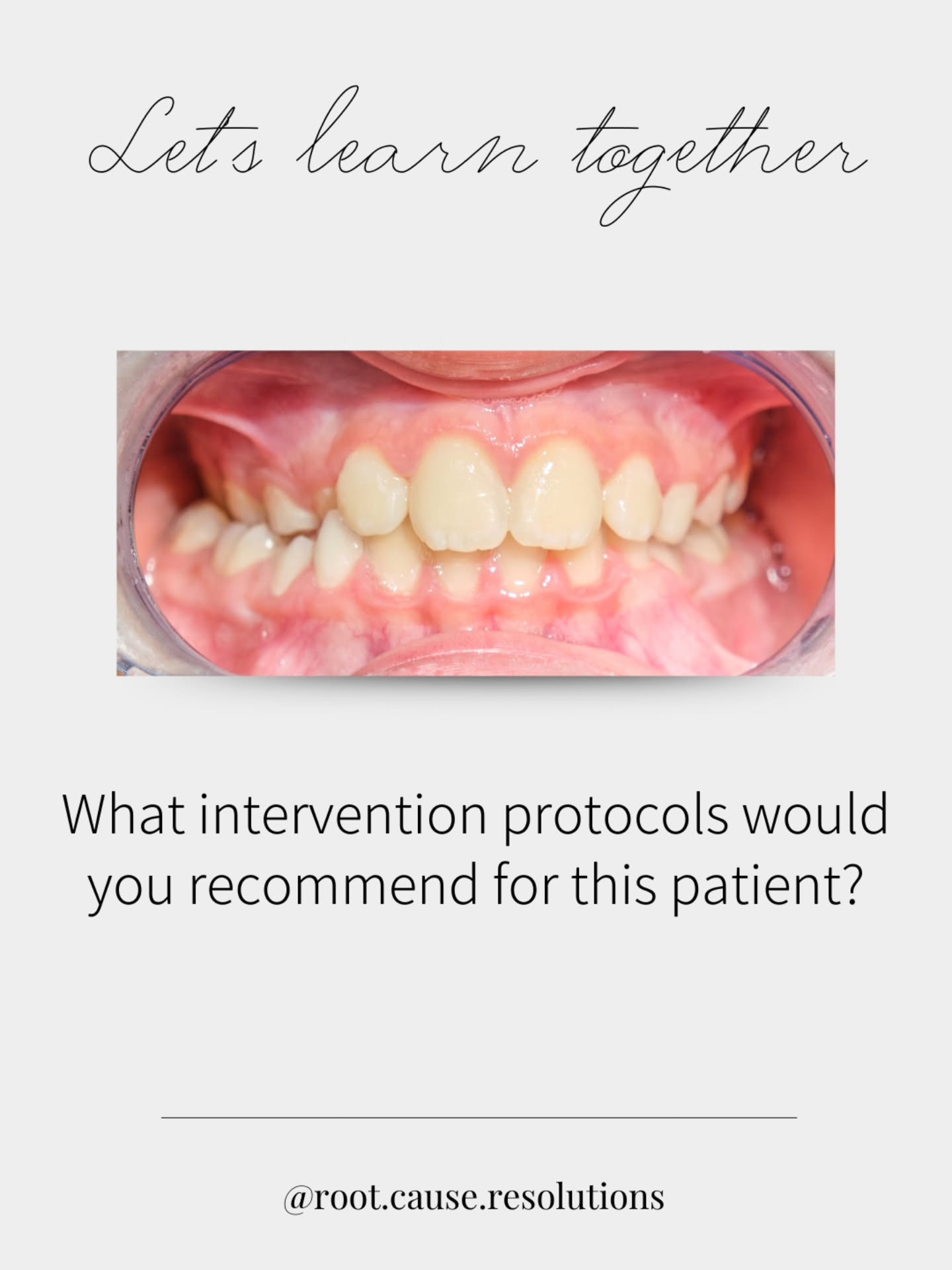 When you look beyond the teeth, you start to see the bigger picture
➡️ Severe crowding
➡️ Crossbite
➡️ Frenum restrictions
➡️ Possible tongue thrust patterns
These findings often reflect underlying issues with airway, oral function, and craniofacial development.
‼️ The real question isn’t just how do we straighten the teeth. It’s what caused this to develop in the first place, and what can we do to support this patient going forward.
✅️ Considerations to include
✅️ Comprehensive airway screening
✅️ Myofunctional assessment and therapy
✅️ Evaluation of oral restrictions
✅️ Orthodontic interventions
✅️ Interdisciplinary collaboration
Modern dentistry is shifting toward identifying and addressing root causes, not just managing the end result.
❓️ What would be part of your treatment conversation?
#airwaydentistry #dentistry #oralhealth #myofunctionaltherapy #RDH