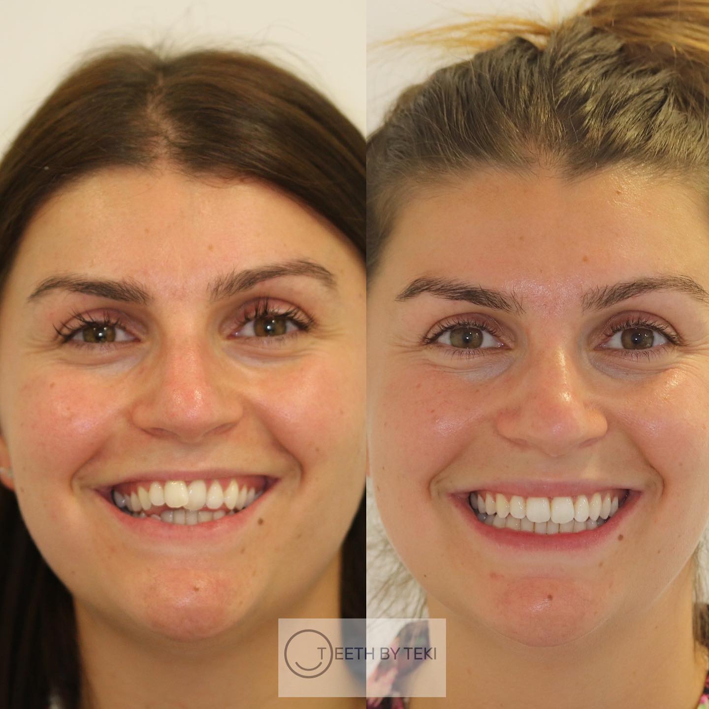 Just Invisalign ⚪️💙
.
.
Keep your teeth healthy
.
.
#teethbyteki #invisalign #yourstyleyoursmile