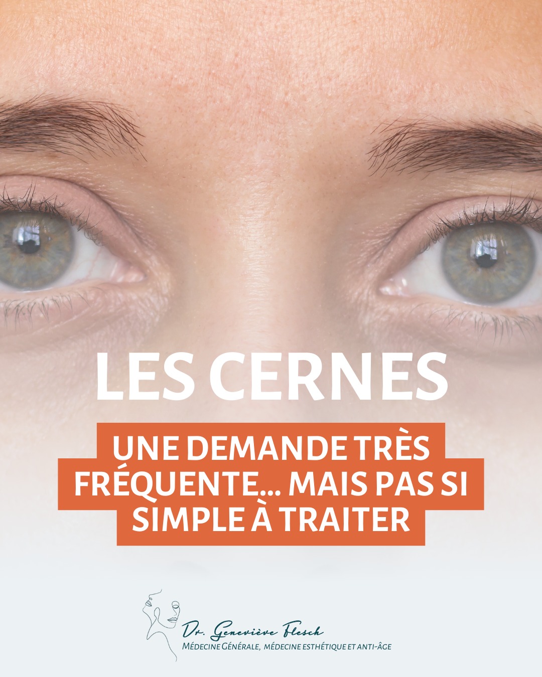 Les cernes font partie des demandes les plus fréquentes en médecine esthétique 👁️
Mais c’est aussi l’une des zones les plus complexes à traiter.
On confond souvent cerne et poche, alors que leur origine est différente… et donc leur prise en charge aussi. 🔎
Et contrairement à ce que l’on imagine parfois, il ne suffit pas d’injecter directement sous l’œil pour corriger le problème.
Le regard s’inscrit dans l’équilibre de tout le visage.
Dans ce carrousel, je vous explique :
✔️ la différence entre cerne et poche
✔️ pourquoi le contour de l’œil est une zone délicate
✔️ et pourquoi une approche globale est souvent nécessaire
Parce qu’un regard reposé ne se traite jamais à la légère ✨
#medecineesthetique #regard #soindelapeau #bienvieillir #medecineglobale