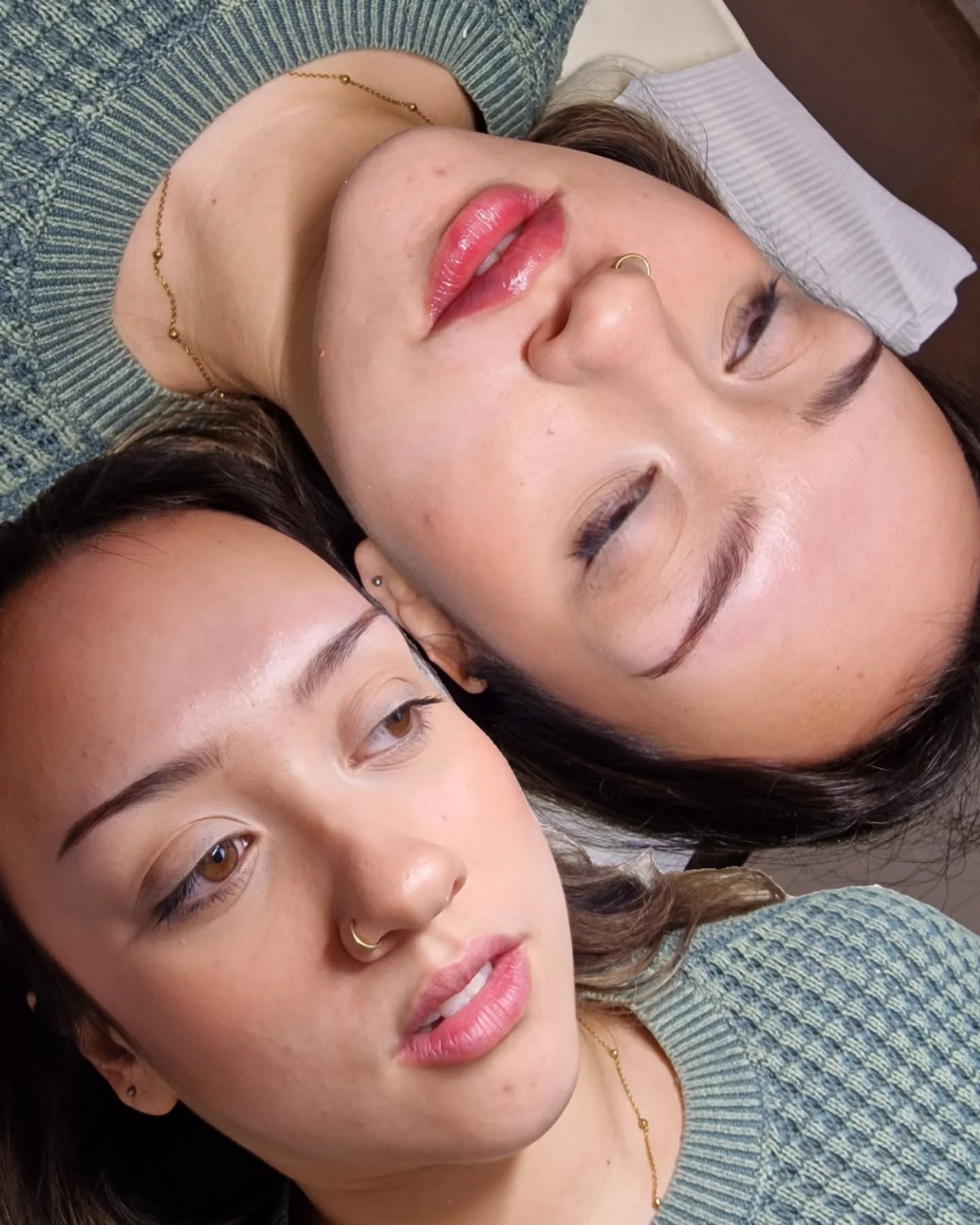 𝐓𝐡𝐞 𝐨𝐧𝐞 𝐬𝐡𝐚𝐩𝐞 𝐭𝐡𝐚𝐭 𝐜𝐚𝐧 𝐞𝐱𝐩𝐨𝐬𝐞 𝐩𝐨𝐨𝐫 𝐭𝐞𝐜𝐡𝐧𝐢𝐪𝐮𝐞 𝐪𝐮𝐢𝐜𝐤𝐥𝐲.
.
"M-shaped" lips can be seen as the middle upper lip carrying more volume than the sides, meaning the centre projects or drops slightly more, while the lateral thirds are much thinner and often appear tucked under.
.
Because of this natural anatomy, placing filler evenly across the entire lip or worse, adding product directly into the centre, can increase that projection even further. The lip can then start to tip forward and downward, creating heaviness and a subtle “shelf” effect when viewed from the side profile. Rather than smoothing the lip contour, this approach actually amplifies the imbalance already present in the lip structure.
.
Treating M-shaped lips correctly requires recognising that the problem is rarely a lack of volume. Instead, it’s about distribution and structural balance. By supporting the lateral thirds of the upper lip while preserving the central tubercle, the lip can be harmonised so the contour flows smoothly from corner to corner.
.
This shape is my absolute favourite to treat, for the results can be quite impressive and dramatic.