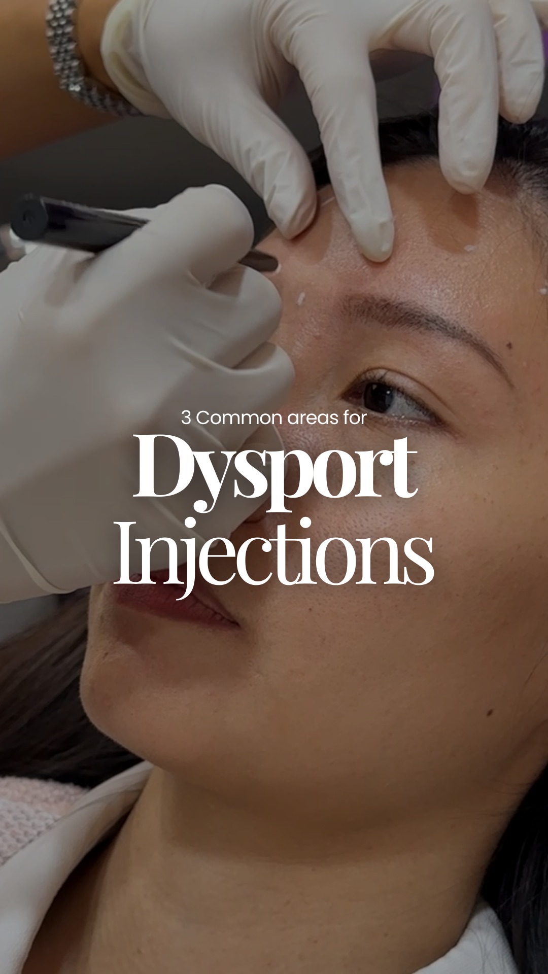 Are you getting the right number of units for your treatment? 🤔
When it comes to neurotoxin injections, the number of units used can make a big difference in your results. Too little may not give the desired effect, while too much may not be necessary for your facial anatomy.
In this reel, Dr Kay shares 3 common areas for Dysport injections and the typical number of units used for each, helping you better understand what goes into a well-planned treatment.
💬 Thinking about Dysport?
Book a consultation with our doctors to find out what works best for you.
