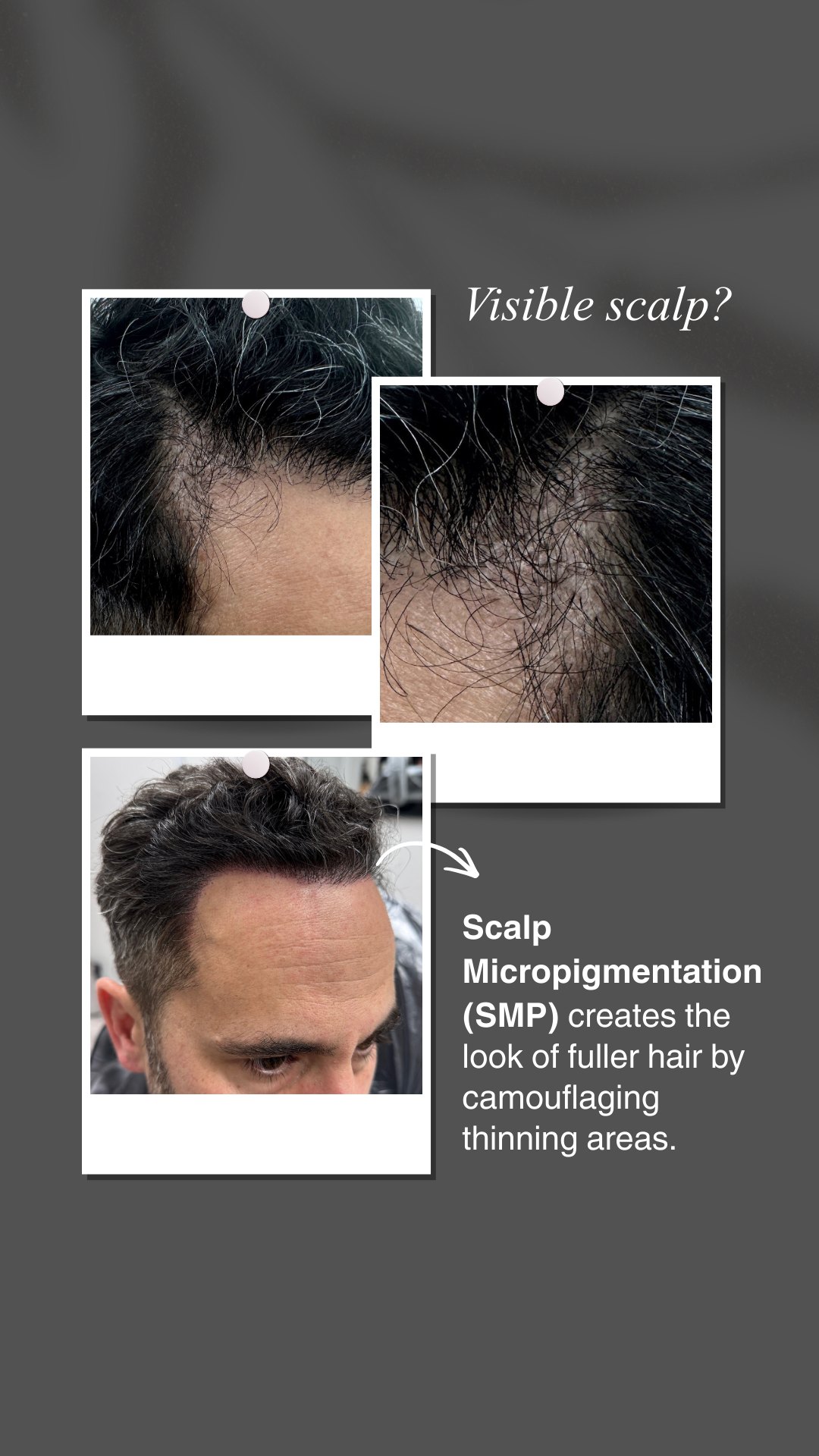 Seeing more scalp than you used to? You’re not alone!! Hair thinning can happen gradually, and for many people the first sign is a more visible scalp around the hairline or part.
Scalp Micropigmentation (SMP) is loved among many of our clients because it's a non-surgical treatment that creates the appearance of fuller hair by carefully placing tiny pigment impressions in thinning areas.
🖤 Every SMP treatment is customized to match your hair color, density, and natural growth pattern, so we promise it looks natural!
Curious if SMP could work for you?
Book a consultation with our team to learn more - link in bio.
#scalpmicropigmentation #hairdensity #pinolesmp #smpartist #bayareasmp