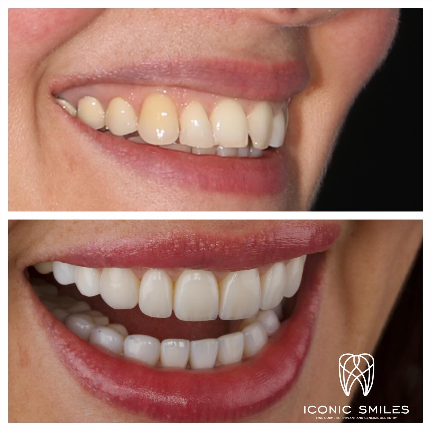 🌟Porcelain Veneers 🌟
Porcelain veneers are not all the same! We have added natural details to the veneers and a glass like finish to the veneers to finish with this rejuvenating smile.
DISCLAIMER
All information provided by Dr Matthew El Azzi - DEN0001996783, Registered Dentist, is for general and educational purposes only. It does not constitute medical advice and should not be relied upon as a substitute for professional consultation.
Images and videos are of real patients who have given consent. No filters, AI enhancements, or unrealistic lighting are used. These materials are intended to demonstrate examples of treatment but do not guarantee results. Individual results, risks, potential complications, and recovery times vary between patients.
Patient stories are individual experiences and should not be interpreted as indicative of expected outcomes for all patients. Your experience may differ.
Before commencing any treatment, you should seek independent advice from a qualified, AHPRA-registered health practitioner and consider obtaining a second opinion.
For details about each specific treatment, head to:
https://www.iconicsmiles.com.au
Dr Matthew El Azzi - DEN0001996783
Registered Dentist, General Registration