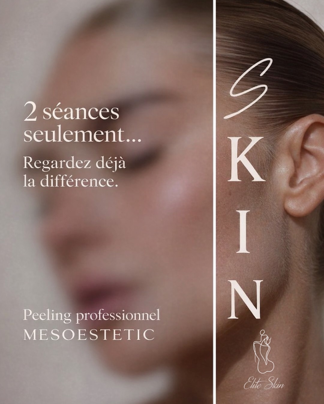 Avant ➝ Après (2 séances)
Un teint plus lumineux,
un grain de peau déjà plus lisse,
et une peau visiblement plus fraîche.
Les peelings professionnels Mesoestetic stimulent le renouvellement cellulaire pour améliorer progressivement la qualité de la peau.
Et ce n’est que la 2ᵉ séance sur 6 ✨#antiage #peeling #mesoestetic #glowing #cambrai