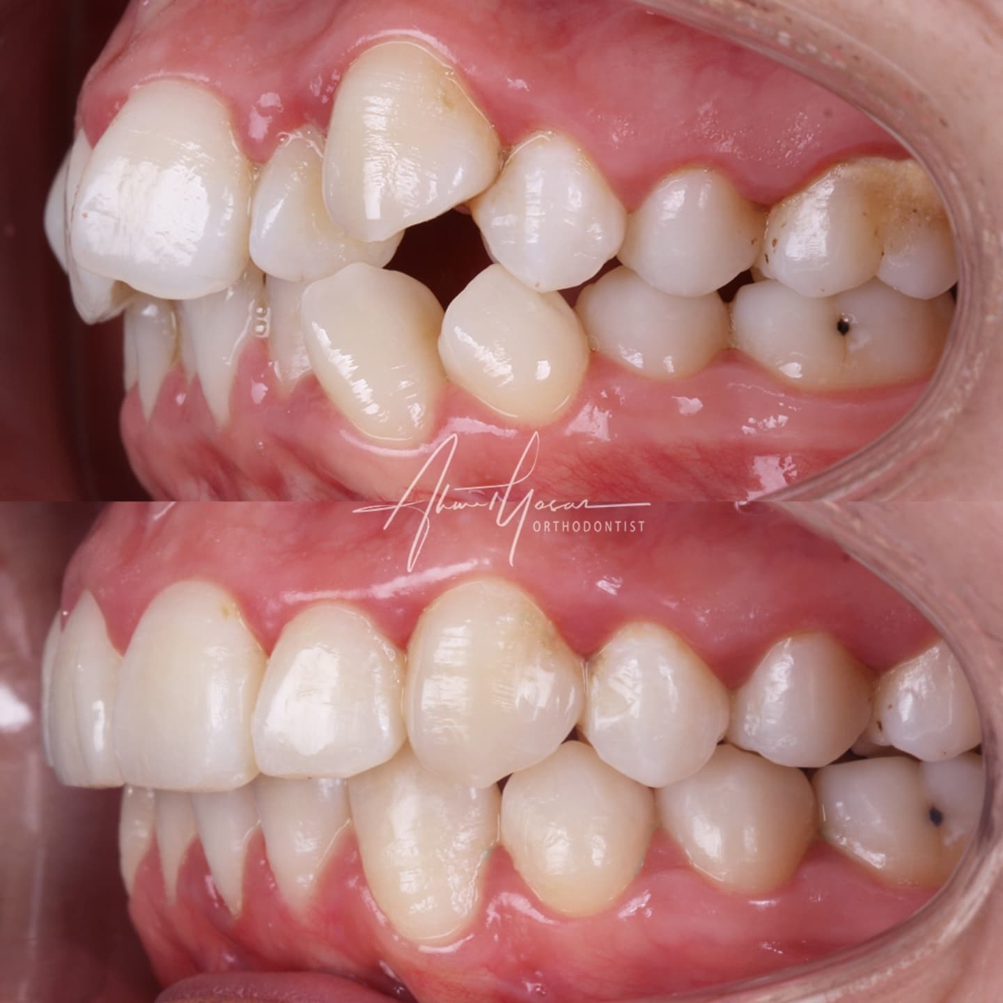 Şeffaf plak / Clear aligners.
.
Our clinic is authorized by the Ministry of Health of the Republic of Türkiye for International Health Tourism. All patients have been informed and have provided consent for the use of their photographs on our social media platforms. All content shared on social media is intended to inform patients about procedures and should not be perceived as advertising. Outcomes of any surgical or interventional treatment may vary from person to person. It is recommended to consult your physician for detailed information before undergoing any procedure.
.
.
.#ortodonti #ortodontist #bursa #bursaortodonti #bursaortodontist #bursaortodontiuzmanı #orthodontics #braces #teltedavisi #dişteli #orthognathicsurgery #invisalign #clearcorrect #şeffafplak #lingualortodonti #dişteli #çeneameliyatı #selfligating #kapaklıbraket #gülüştasarımı #dent #dentistry #photography #estetik #dentalart #ahmetyasar #drahmetyasar