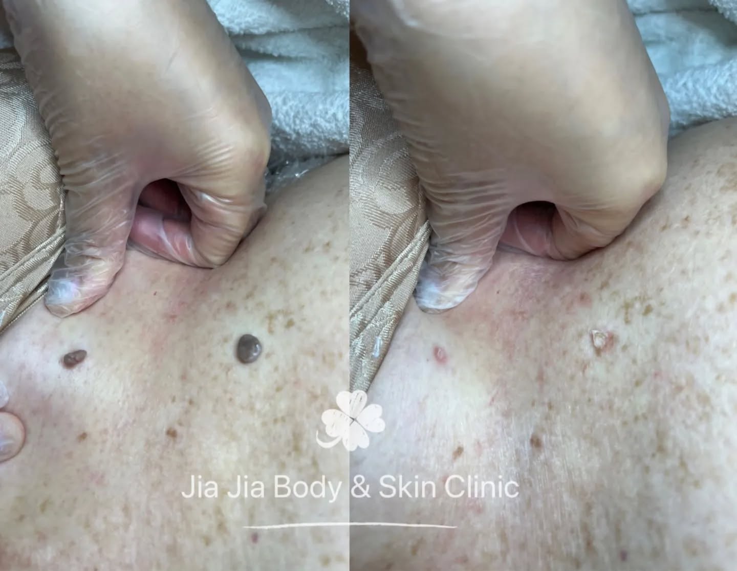 Don't swipe to the last photo if you are eating 😜.
These skin tags tend to grow around sweaty areas like underarms and under the bra line. Some have stalks like mushrooms which makes it easier to remove. 🍄☺️👍
but flat ones can also be removed too as long as none of them are cancerous! One treatment is all it takes... maybe an extra one if you have heaps of skin tags or if you need a touch up.
With the radio frequency laser, it doesn't grow back either! Come in for a free consultation anytime 😉
#beauty #lasertreatment #skintagremoval #skintag #clearskin #toprydecity