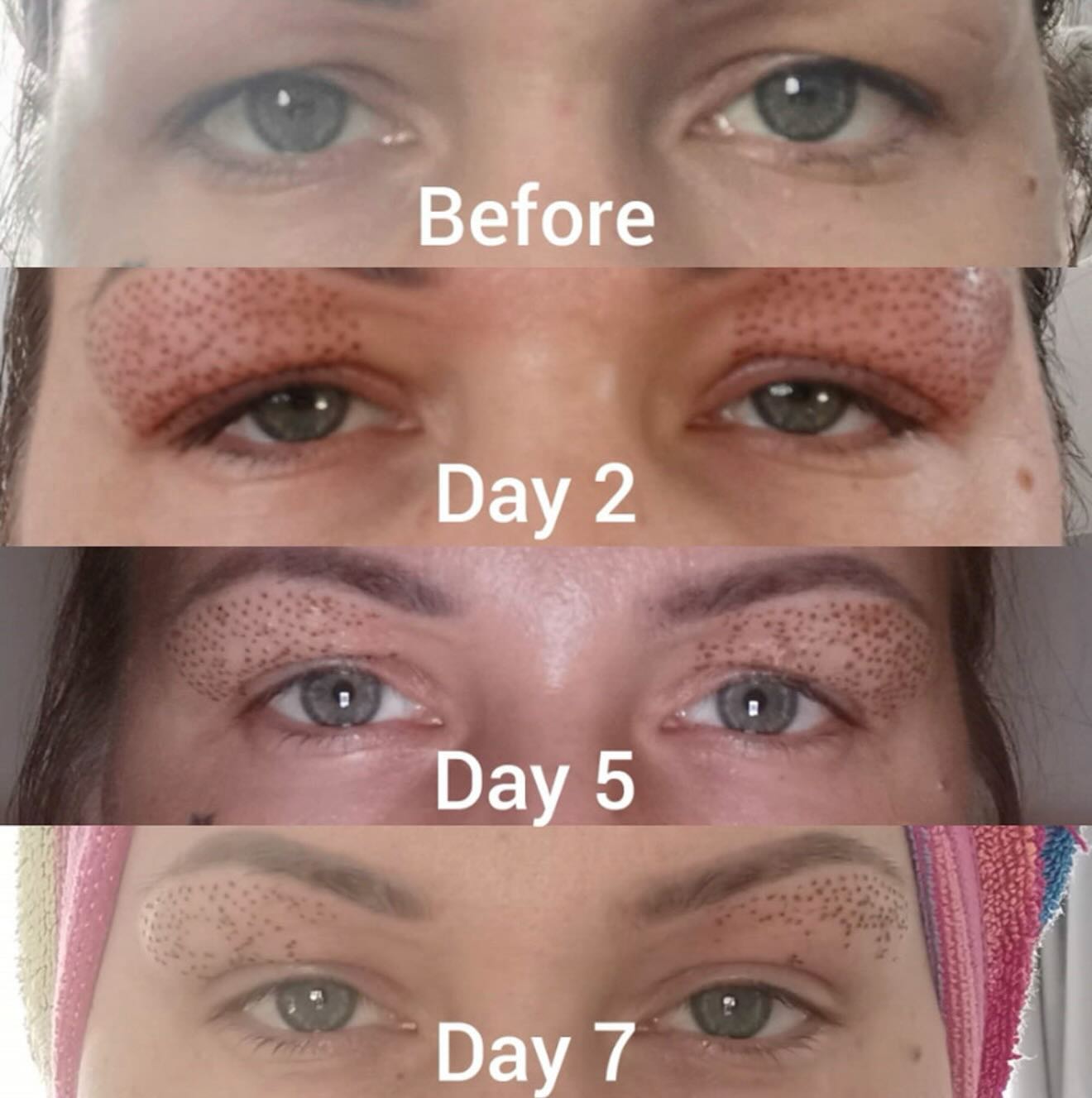Lifted, tightened, refreshed… without surgery 👁️✨
Upper & lower eyelid rejuvenation using the plasma fibroblast pen 💫
This treatment works by creating tiny micro-traumas to the skin, stimulating collagen + elastin production for a natural tightening effect.
💉 Treats:
• Hooded upper eyelids
• Under-eye crepey skin
• Fine lines & wrinkles
• Mild skin laxity
🔥 Results:
• Firmer, lifted eye area
• Smoother skin texture
• Brighter, more youthful appearance
⏳ Downtime: 5–10 days (small carbon crusts + swelling expected)
📆 Results improve over 6–12 weeks as collagen rebuilds
💡 Perfect for clients wanting a non-surgical alternative to blepharoplasty.
📩 DM to book or for a consultation
#plasmafibroblast #blephoraplasty #hoodedeyelids #eyebags #eyewrinkles