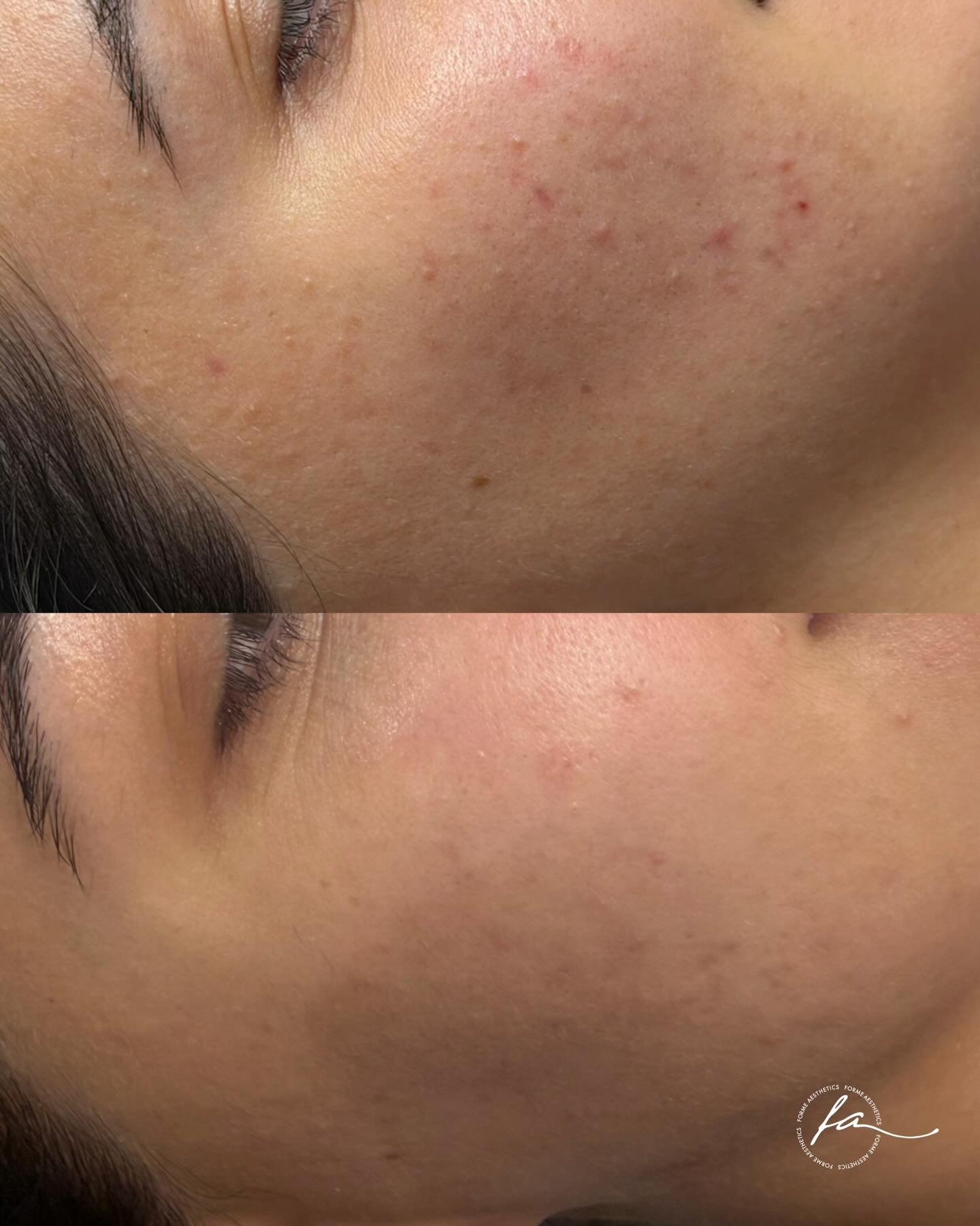 Skin looking dull, congested or uneven? Read on to learn about what treatments were used to achieve this result.
SkinPen works by triggering your skin’s natural repair process. During the proliferation phase, new collagen and skin cells are formed, improving skin quality over time.
I pair it with Klardie D&R to support that process, containing:
• Hyaluronic acid for hydration
• PDRN to support repair
• Niacinamide + tranexamic acid for tone
• Vitamin C + glutathione for antioxidant support
Results build with consistency:
Smoother texture, clearer skin, more even tone.
A series, spaced 4 weeks apart, is where you see the difference.
Forme Aesthetics
Book via link in bio or call 0414006876