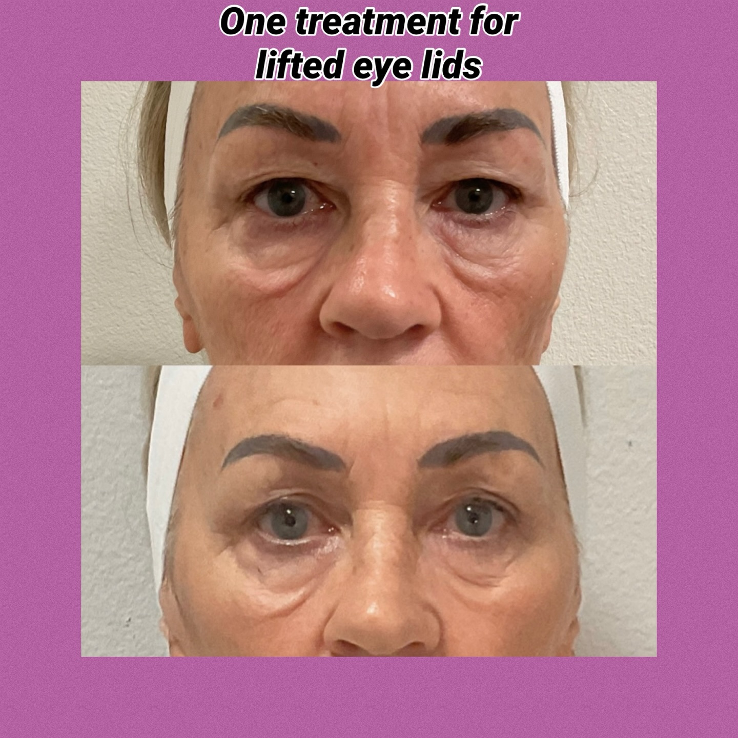 #hifu #co2laser #sarasotawoman #sarasota_fl #skinrejuvenation
Capricebeautybar.com