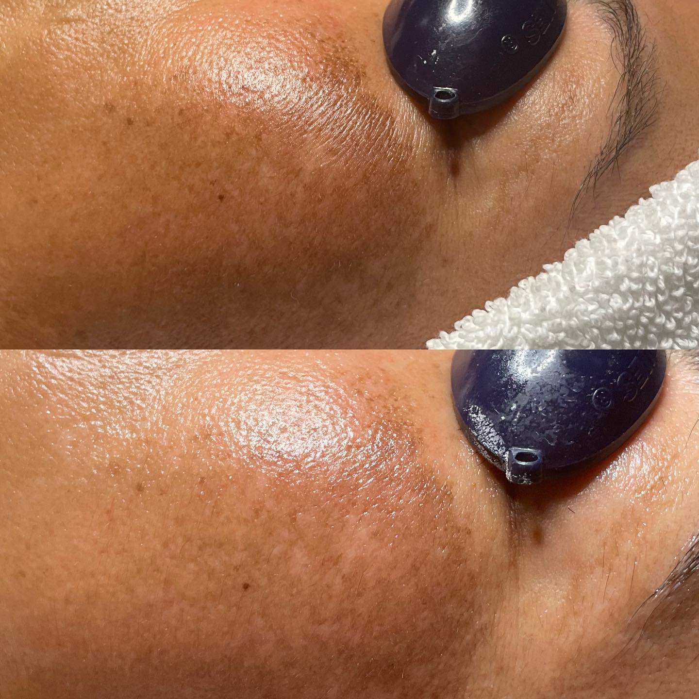Just one intensive customized facial and we achieved this! Used all @circadia products in this facial and their amazing oxygen treatment.
•
•
•
•
•
#CircadiaFacial#Circadia#CircadiaSkin#OxygenTreatment#BrighteningTreatment#OrangeCountyEsthetician#Esthetician#WestministerCalifornia#HuntingtonBeachEsthetician