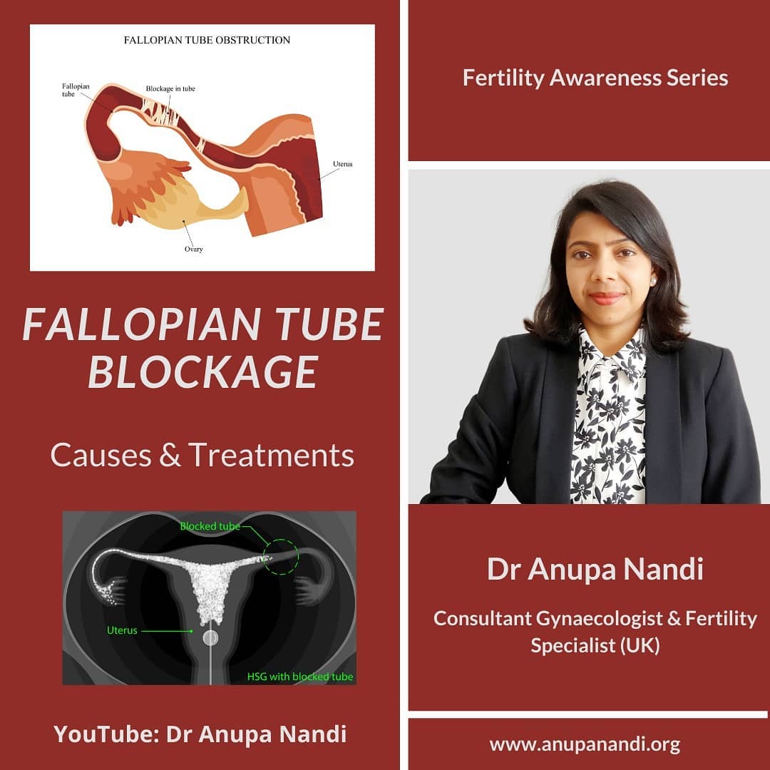 Fallopian tubes are essential for successful conception. One-third of the cases of infertility are due to blocked tubes.
In this video we discussed commonly asked questions:
1. What are the function of the Fallopian tube?
2. What causes damage to the Fallopian tubes?
3. What are the symptoms of tubal damage?
4. How to diagnose tubal block?
5. I have only one fallopian tube, is it possible for me to get pregnant?
6. What are the options if both tubes are blocked?
7. Can you open a blocked tube without surgery?
8. How do you treat hydrosalpinx?
.
.
#fallopiantubes #fallopiantube #fallopian #fallopiantube #fallopiantubeblockage #fallopiantubeblock #fallopiantubesblockage #fallopiantubsblockage #tubalblockage #tubalfactor #infertilityawareness #infertilitywarrior #infertility #infertilitysupport #fertility #fertilityjourney #fertilitysupport #fertilitysupport #fertilityawareness #hsg #hsgtest #hycosy #hycosyscan #ivf #ivfjourney #ivfsuccess #ivfcommunity #ivfwarrior #hydrosalpinx #hydrosalpinxawareness #hydrosalpinxwarriors