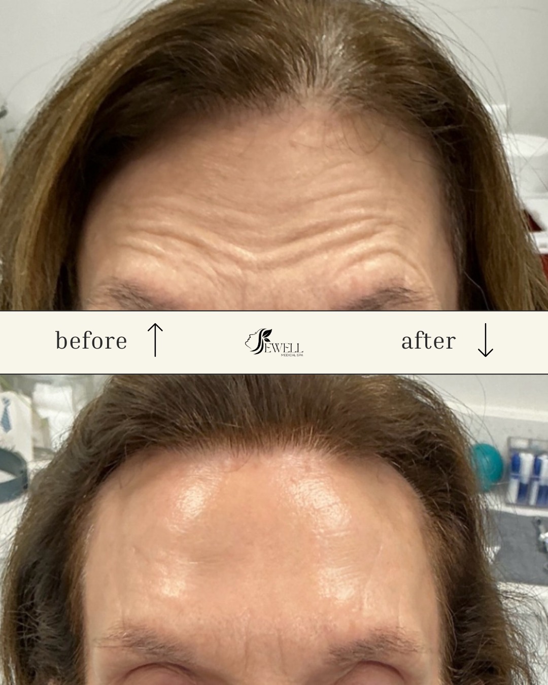 Turn back the clock without losing your natural look ✨💉 Smooth, subtle, and simply you.
Call or text today to book your appointment!
☎️ 239-448-3383
📩 chris.jewell@jewellmedicalspa.com
🌐 www.jewellmedicalspa.com | www.mrinjectable.com
📍 1044 Castello Drive, Ste 213 Naples Florida 34103
💳 We Accept Care Credit!
*
*
*
#botox #botoxinjections #botoxbeforeandafters #foreheadbotox #botulinumtoxin #injectables #cosmeticinjectables #aesthetics #beauty #naplesbeauty #naplesinjector #medspa #bestaestheticinjectors #beforeandafter