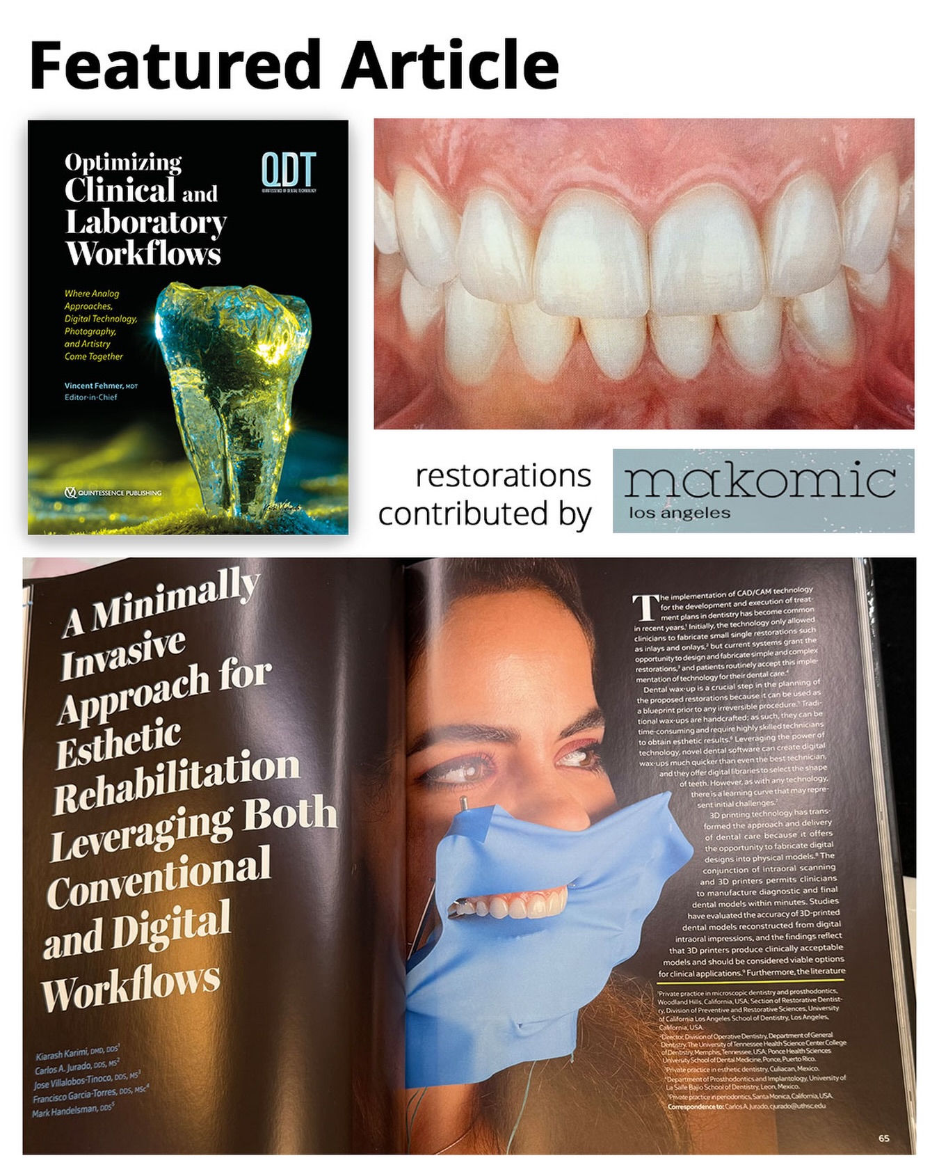 We are pleased to share an article published in the 2026 edition of QDT (Quintessence of Dental Technology) written by Dr. Kia Karimi. The article presents a minimally invasive approach for esthetic rehabilitation using both conventional and digital workflows. Best of all is our long-time and awesome customers at Makomic Inc fabricated the restorations featured in the publication!
.
We love that our customers get recognized for their hard work and dedication into the Dentistry world!
.
📚 For more information on what ETI can do for your clinical office or dental lab, please contact ETI Digital Technology today at 714-238-1490 or sales@etidigitaltechnology.com. You can also visit our 🌐 website at https://www.etidigitaltechnology.com for more information!
.
#customersuccess #featured #makomicinc #loveourcustomers #ETIDigitalTechnology