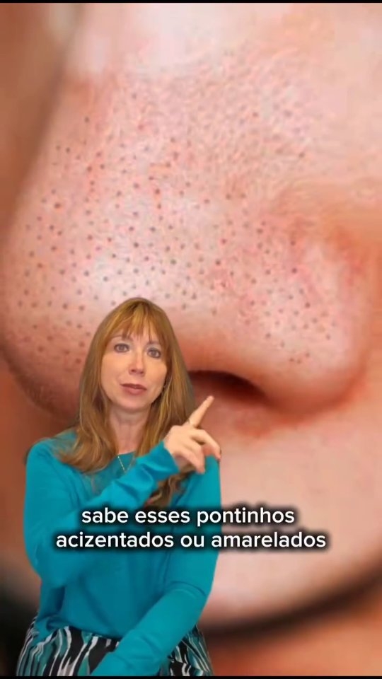 Pare de espremer o seu nariz agora! 🚫👃
Sabe esses pontinhos que você vive tentando "limpar" na frente do espelho? Na maioria das vezes, eles não são cravos, mas sim Filamentos Sebáceos — uma estrutura natural e necessária para a saúde da sua pele.
Ao espremer, você não está limpando; você está dilatando seus poros e destruindo a elasticidade da pele. O resultado?
Poros cada vez maiores e mais visíveis. 🧬🥺
▶️ Assista ao vídeo para entender a diferença e como tratar do jeito certo, sem agressão!!!
QUER O MEU GUIA DE ATIVOS?
Eu preparei o passo a passo para deixar o nariz lisinho sem precisar espremer nada.
👇 Comenta "ROTINA" que eu te envio agora no Direct!
#filamentossebaceos #skincaretips #dermatologia #porosdilatados