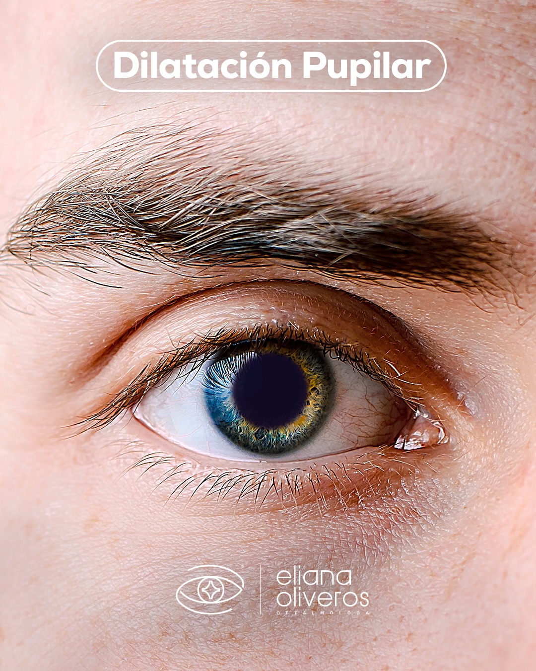 👁️Mucha gente le huye a la dilatación pupilar porque ven borroso por un par de horas, pero la realidad es que ese pequeño paso es nuestra “ventana” directa a tu salud visual.
💬A través de una pupila dilatada, podemos evaluar el fondo de tu ojo y encontrar enfermedades silenciosas mucho antes de que notes el primer síntoma.
Desliza en el carrusel para descubrir todo lo que este sencillo examen nos permite ver. 👉